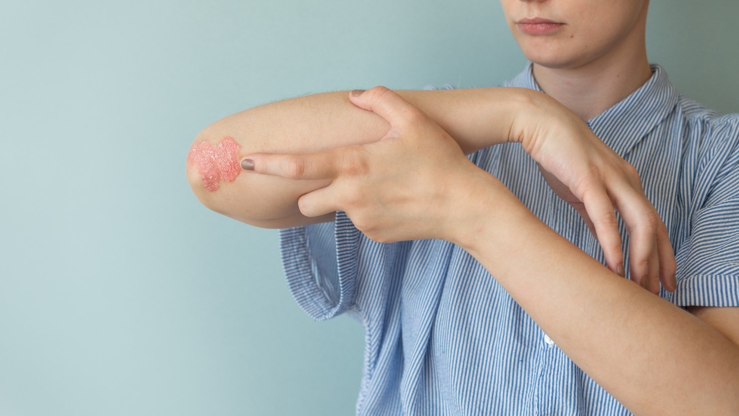 Lupus ban đỏ dạng đĩa có thể khu trú hoặc lan tỏa