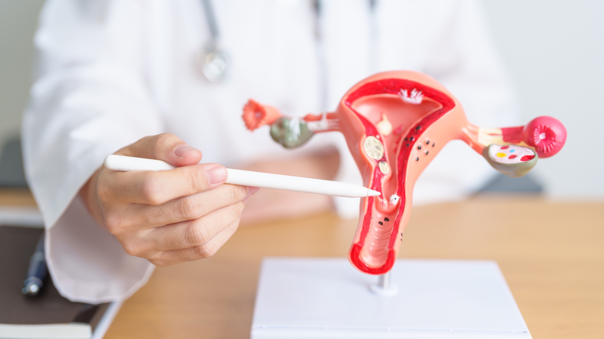 Lạc nội mạc tử cung gây dính vùng chậu và làm ảnh hưởng đến hoạt động của vòi tử cung