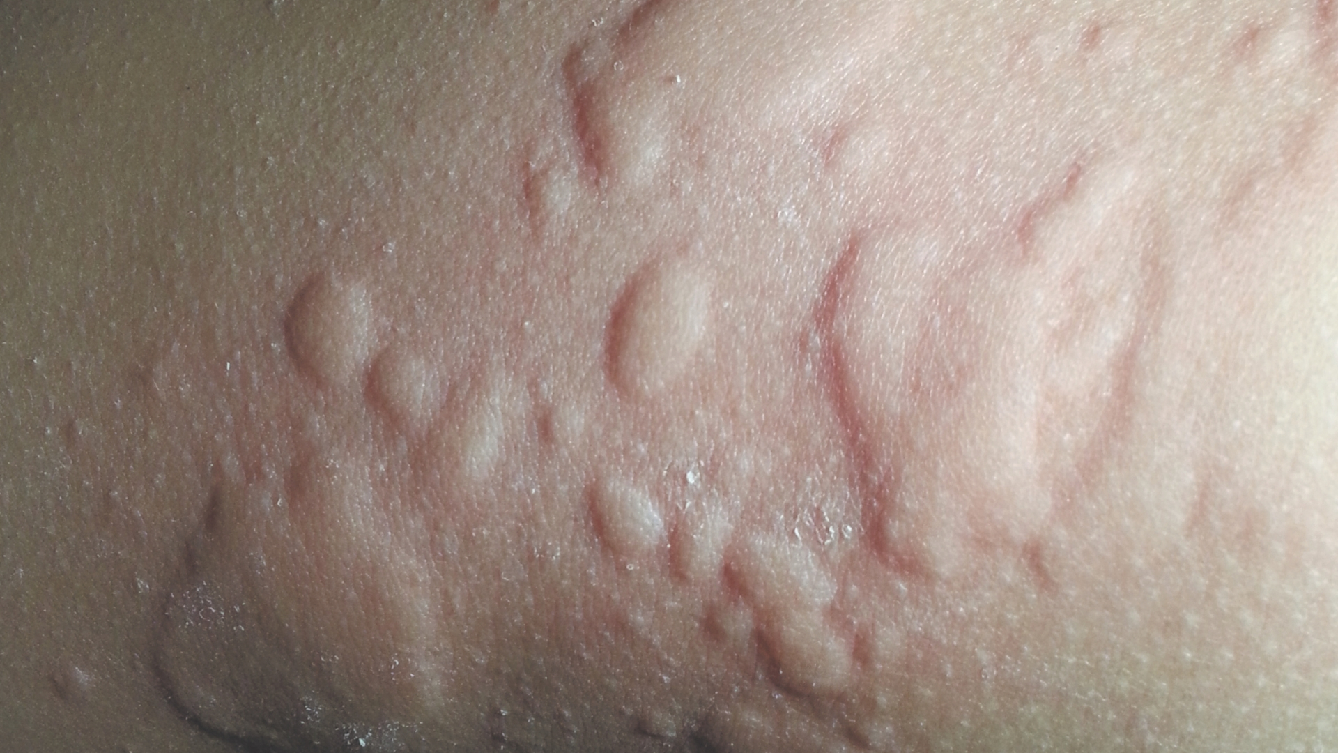 Triệu chứng điển hình nhất của mề đay là sự xuất hiện của các sẩn phù - nốt sưng đỏ trên bề mặt da