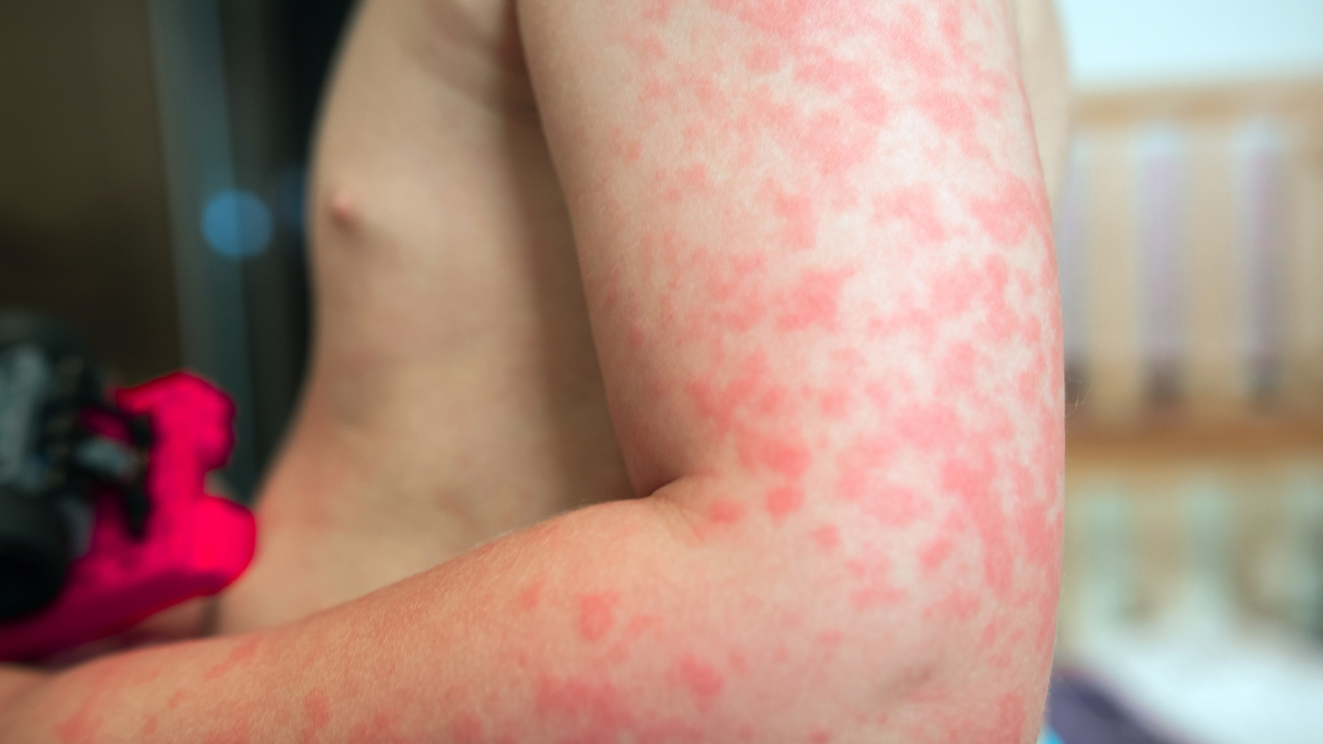 Phản ứng dị ứng là nguyên nhân chính gây mề đay cấp tính