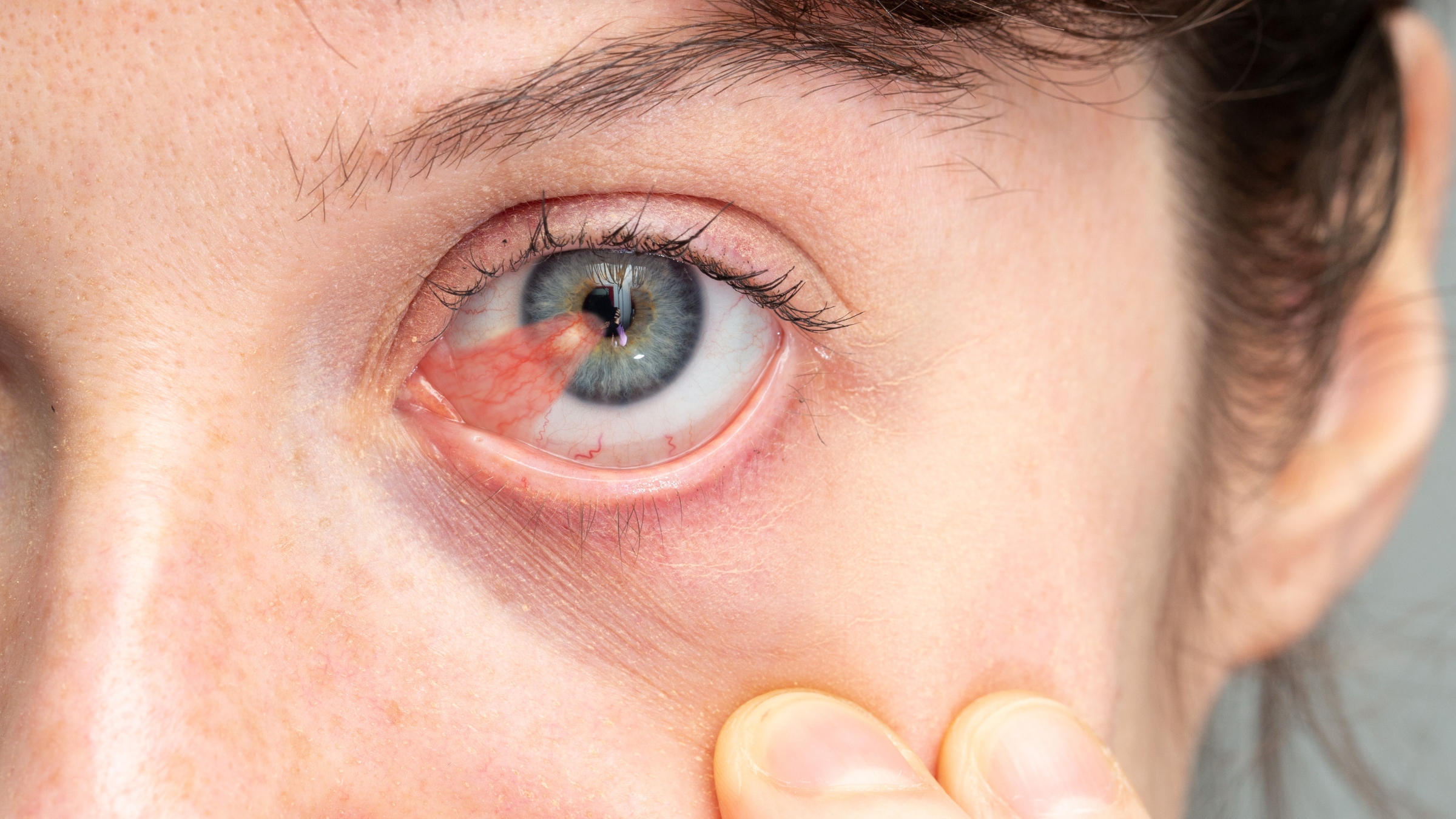 Quan sát bằng mắt thường có thể thấy một mô hình tam giác hoặc cánh màu hồng nhạt hoặc trắng đục, phát triển từ rìa giác mạc vào trung tâm