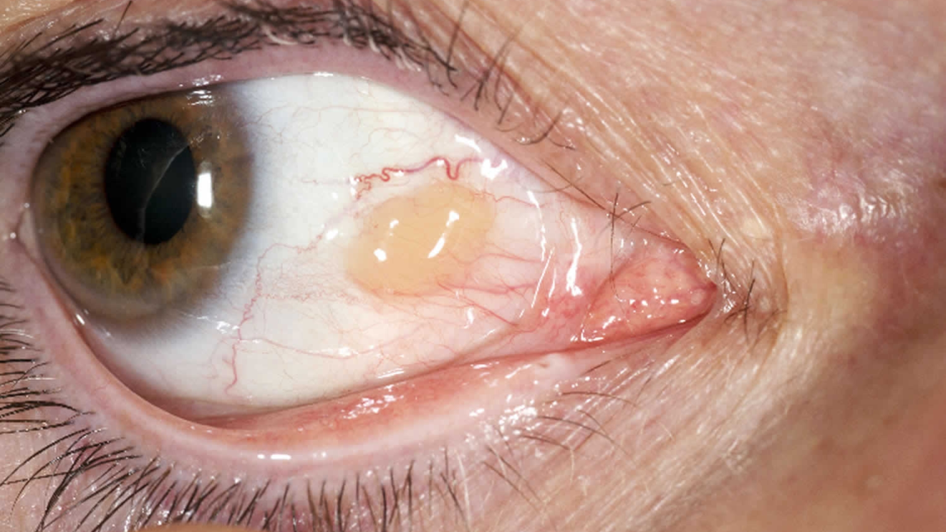 Dấu hiệu đặc trưng nhất của mộng mỡ mắt là một mảng hoặc nốt màu vàng nhạt, hơi gồ lên, khu trú ở vùng kết mạc gần rìa giác mạc