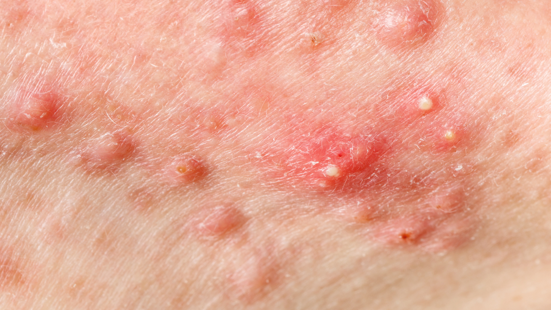 Mụn bọc có thể tồn tại sâu dưới da gây đau nhức và dễ vỡ dẫn đến tình trạng viêm da lan rộng