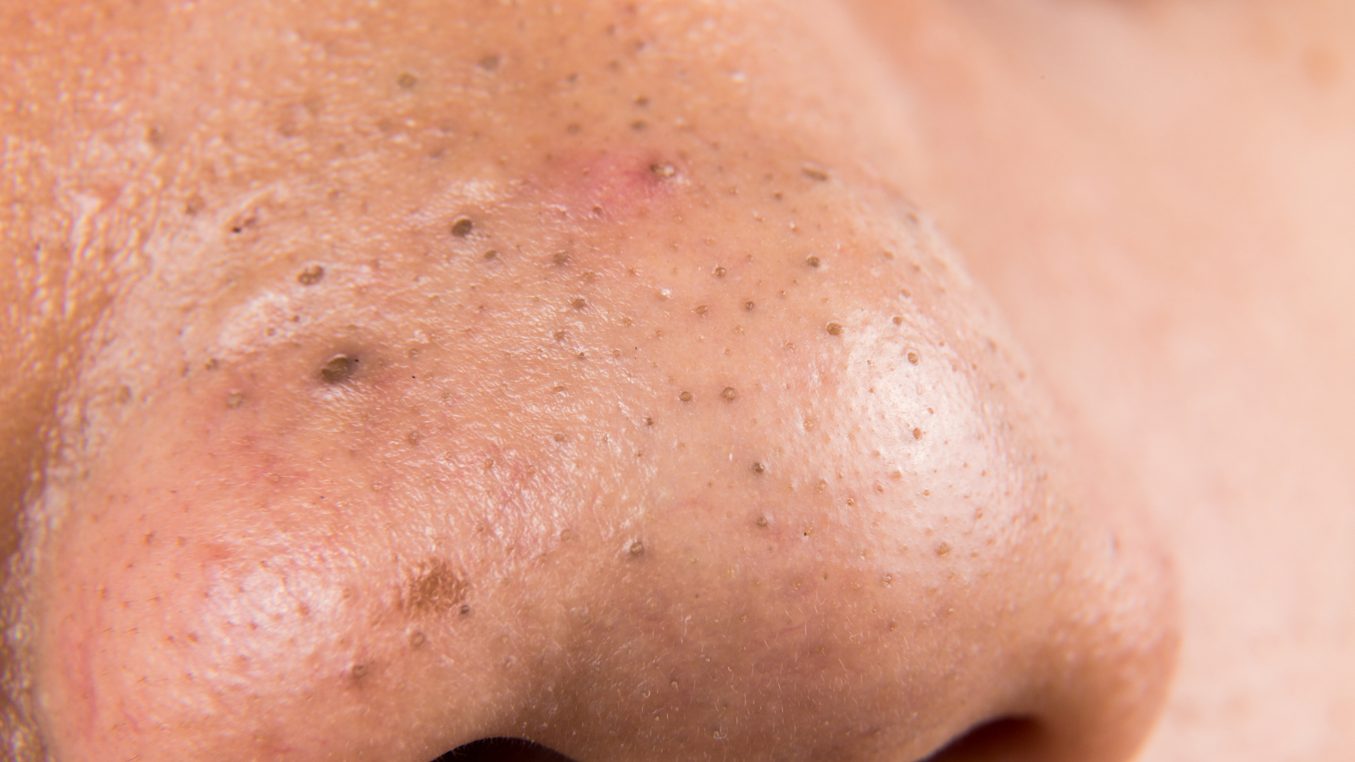 Mụn đầu đen có thể khiến da mặt sần sùi