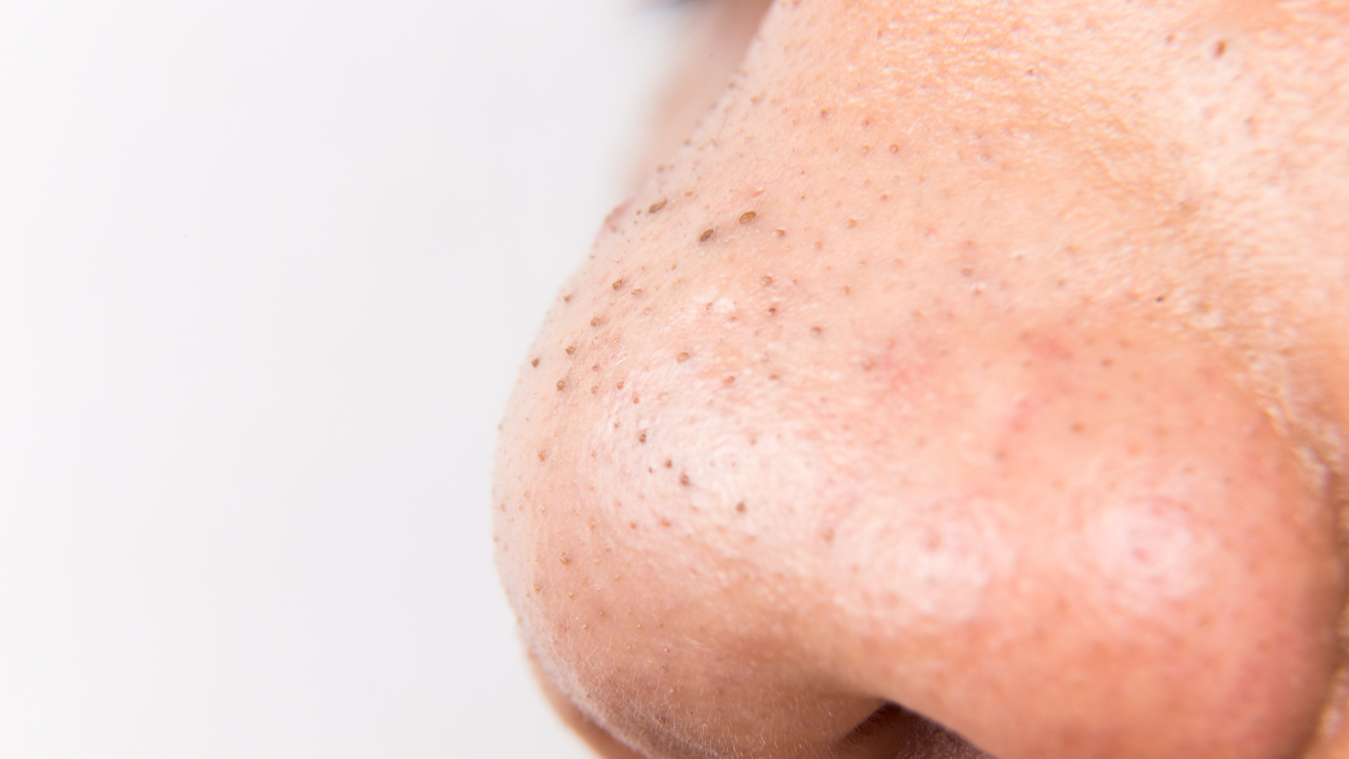 Người bệnh nên đi khám nếu bị mụn đầu đen kéo dài