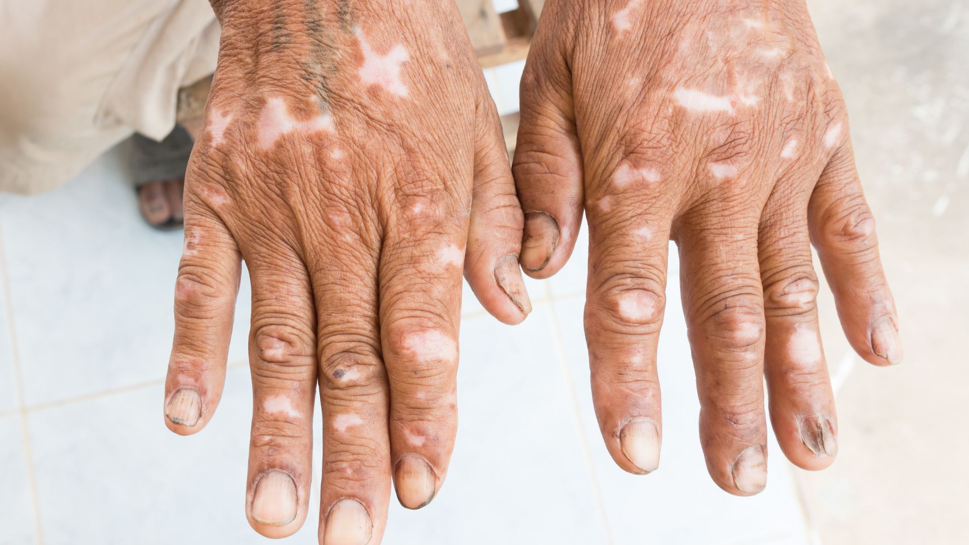 Lang ben là các dát hoặc mảng đổi màu da, có thể trắng, vàng nhạt, hồng hoặc nâu