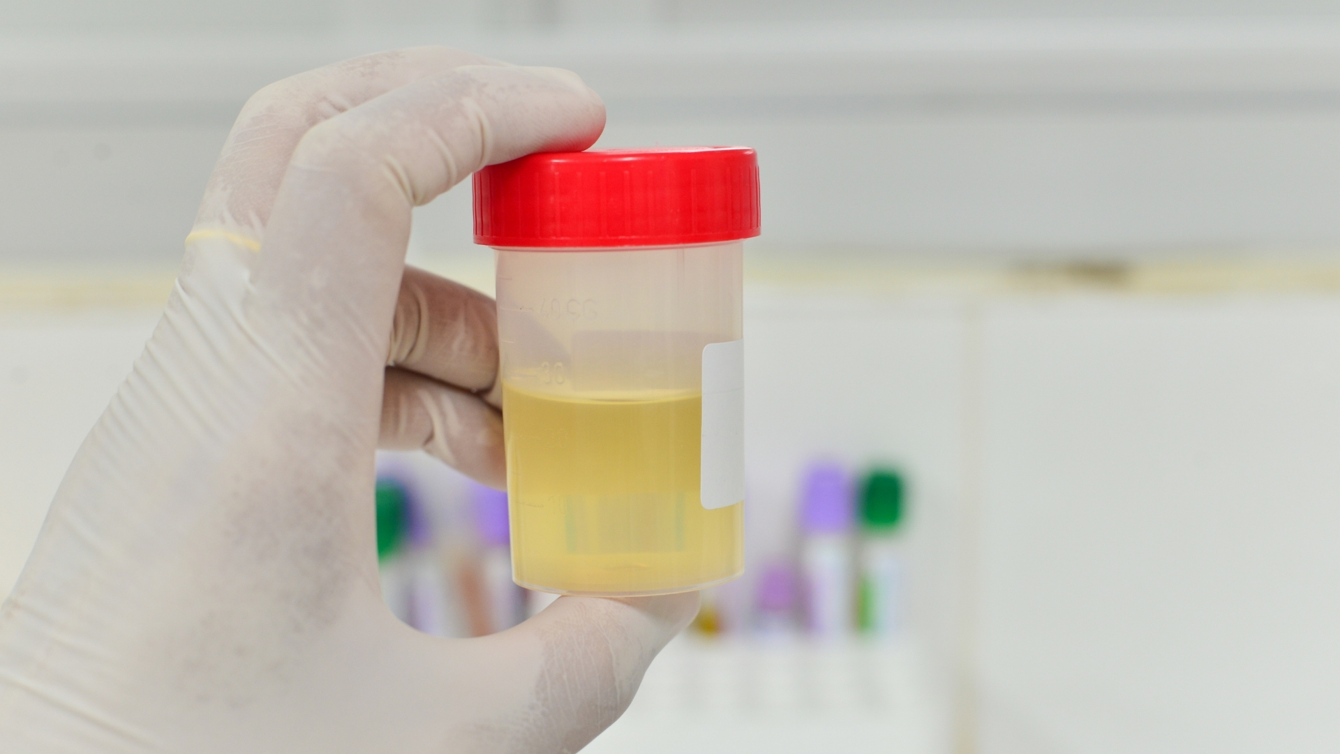 Phân tích nước tiểu là xét nghiệm cơ bản nhưng rất quan trọng, giúp phát hiện nhiễm trùng, tiểu máu vi thể, protein niệu hoặc các bất thường khác