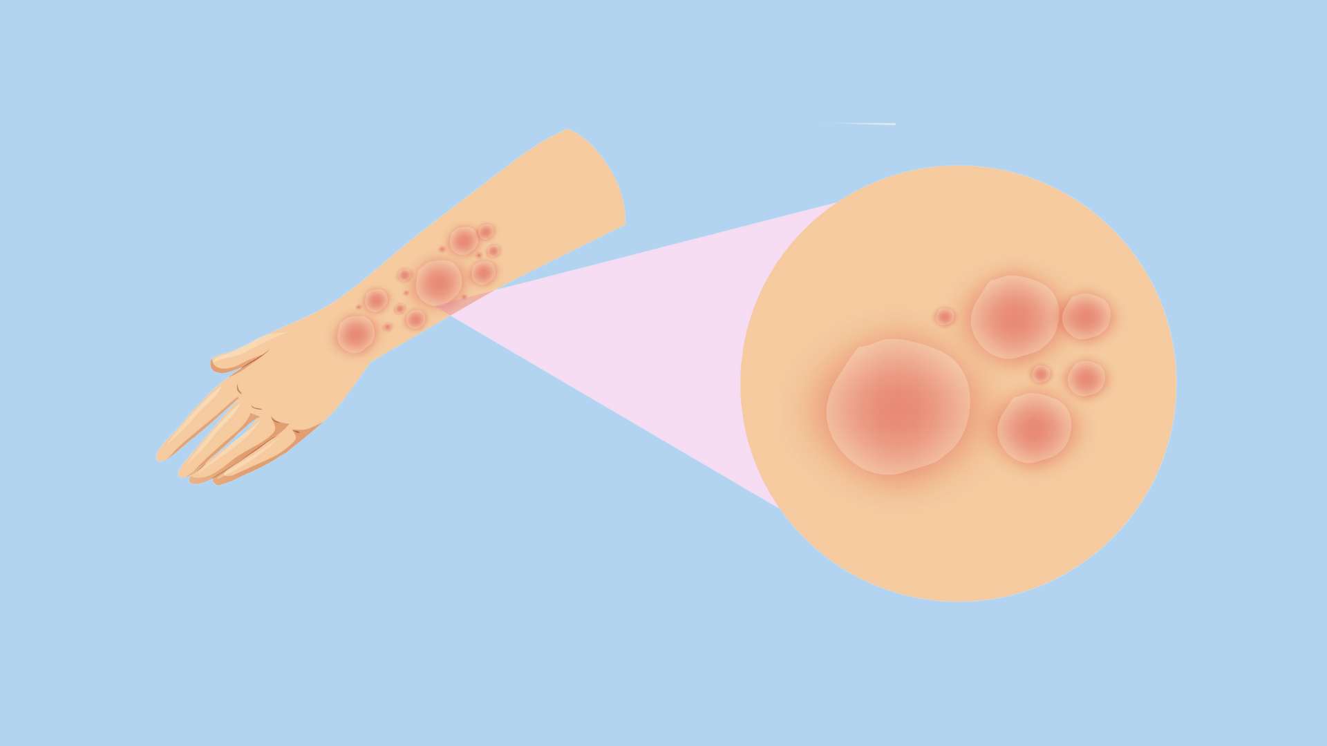 Rộp da gây ra nhiều triệu chứng khó chịu cho người mắc