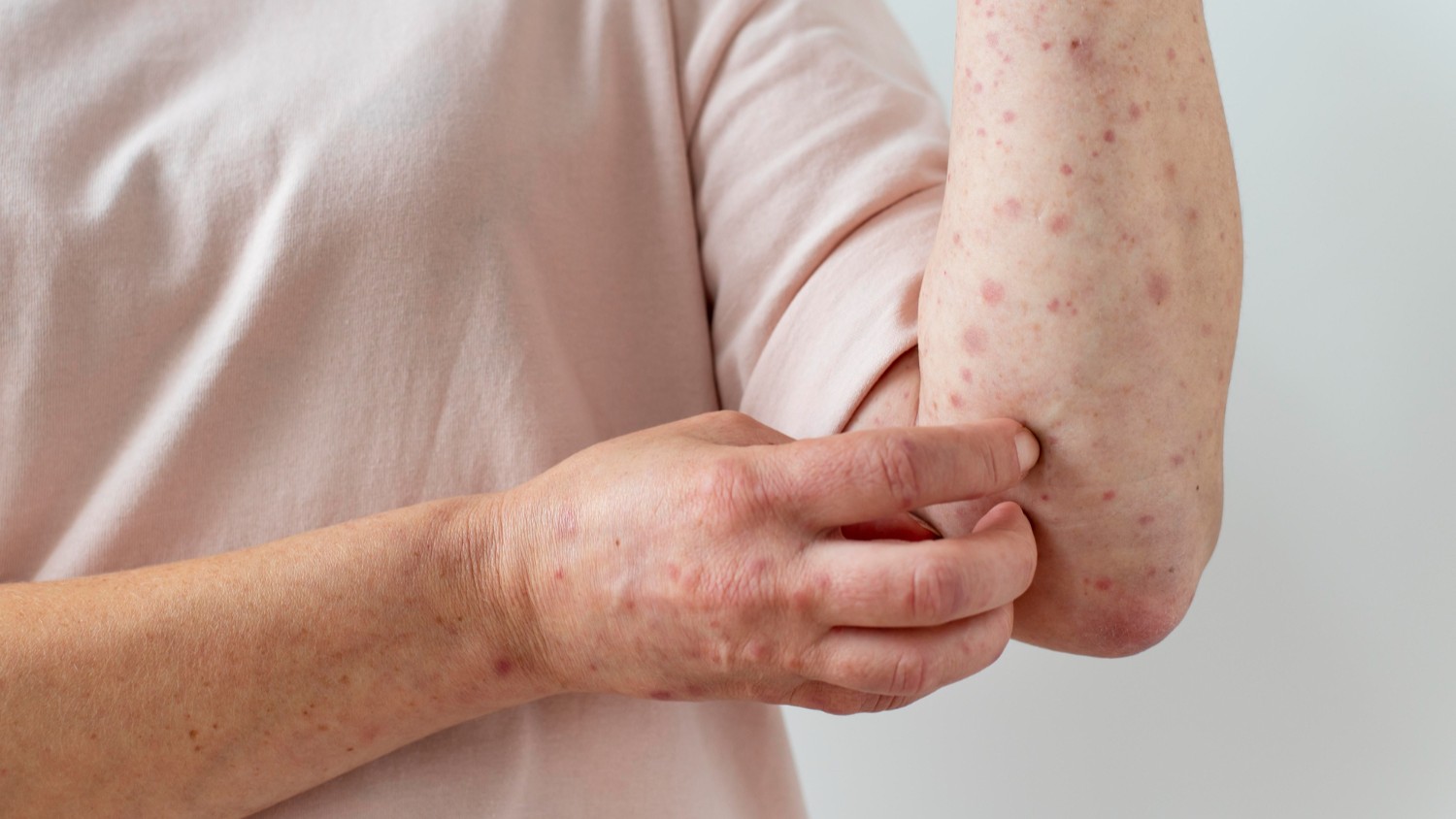 Sẩn giang mai có kích thước từ vài milimet đến một centimet, màu hồng tươi hoặc đỏ đồng