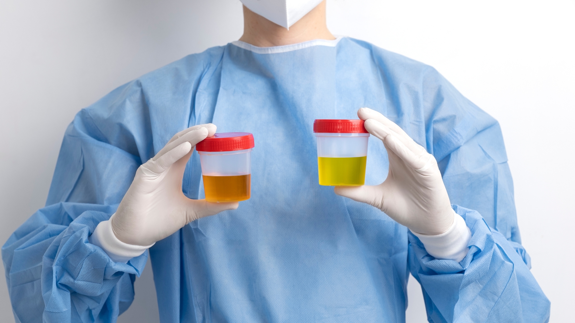 Phân tích nước tiểu giúp cung cấp nhiều thông tin về tình trạng thận