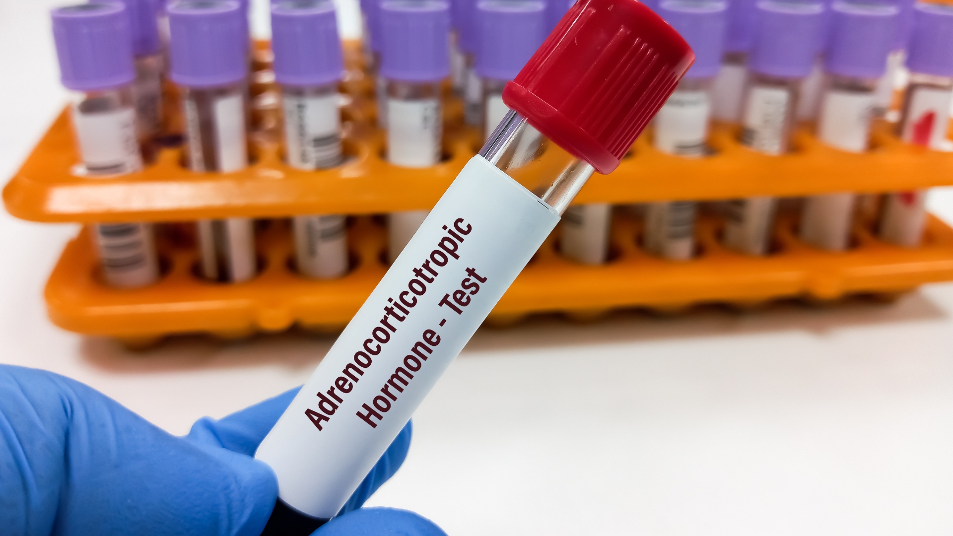 Định lượng ACTH huyết tương giúp định hướng nguyên nhân suy thượng thận