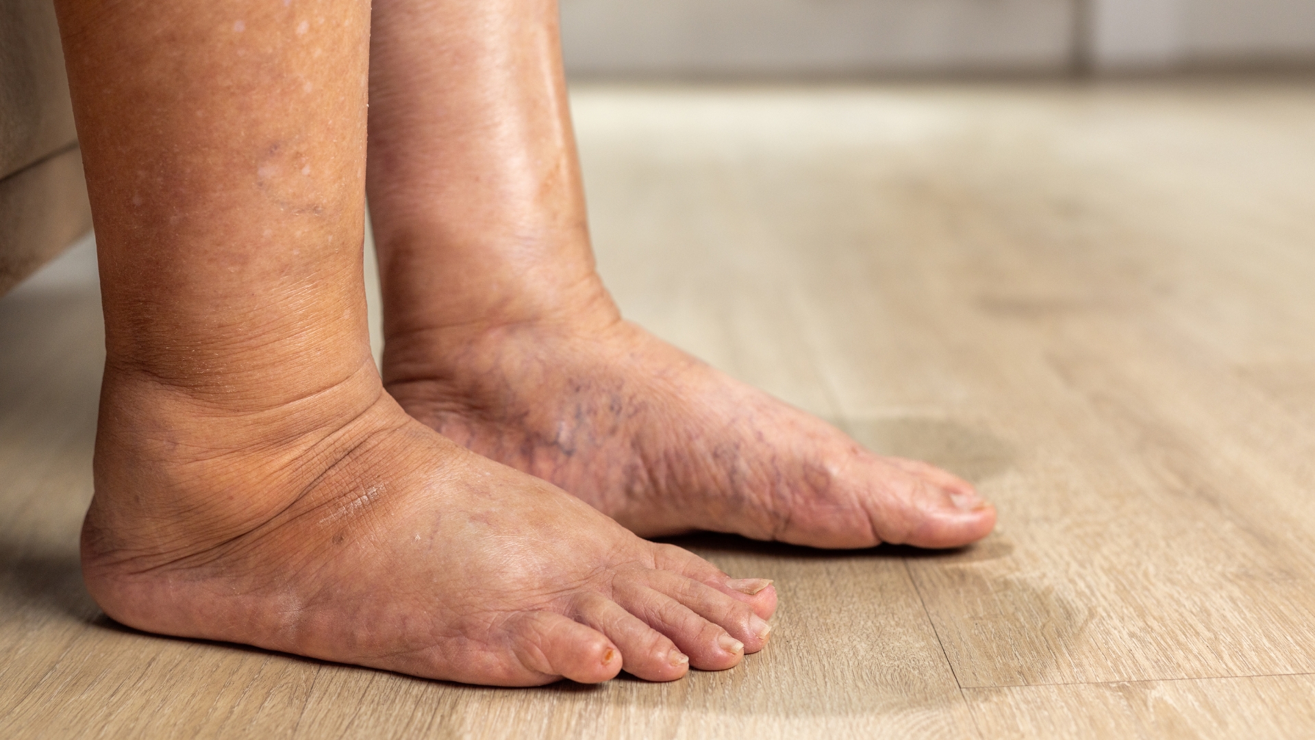 Phù chân là một trong những dấu hiệu phổ biến nhất của suy tim phải