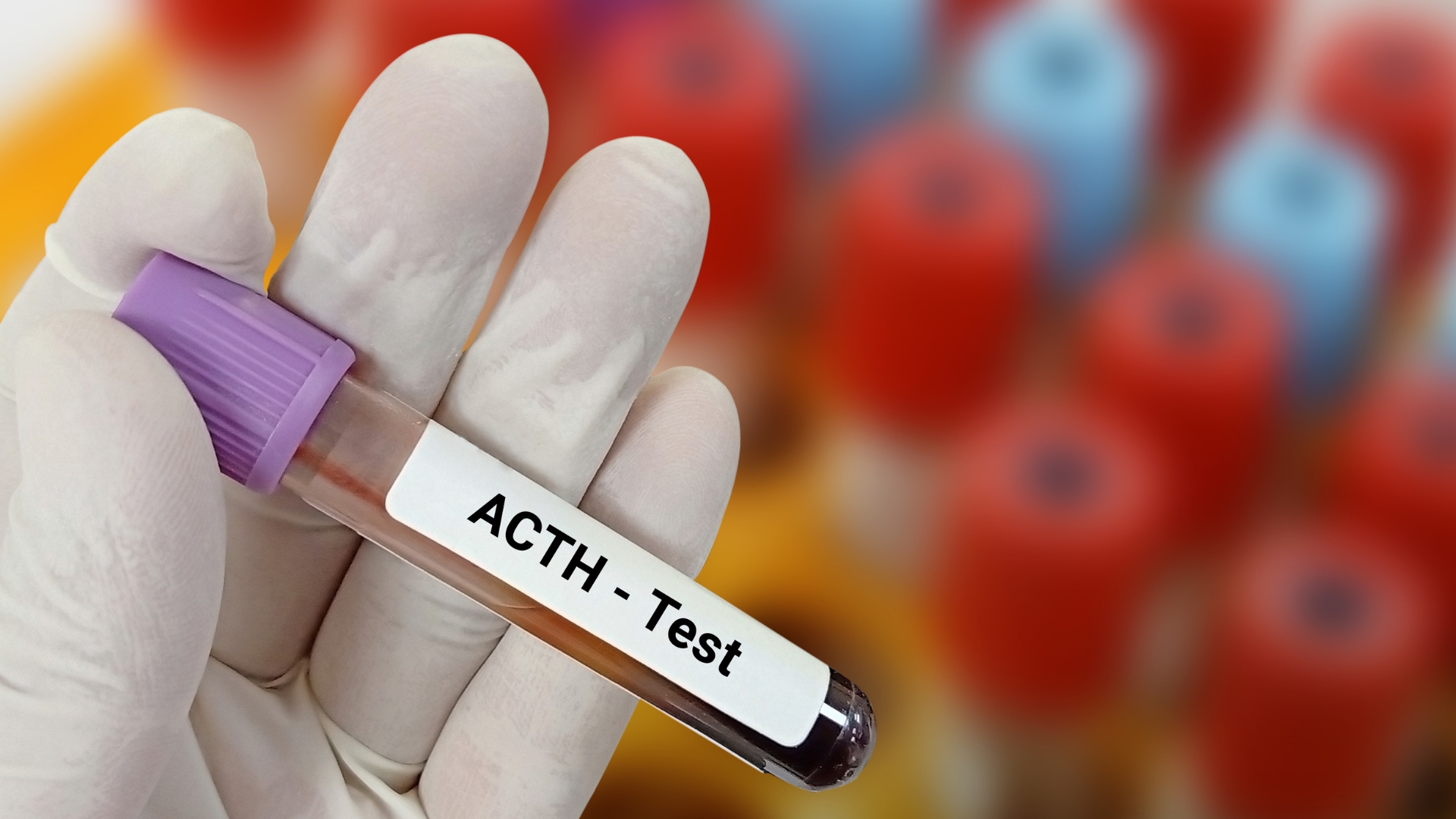 Định lượng ACTH giúp phân biệt các thể suy vỏ thượng thận