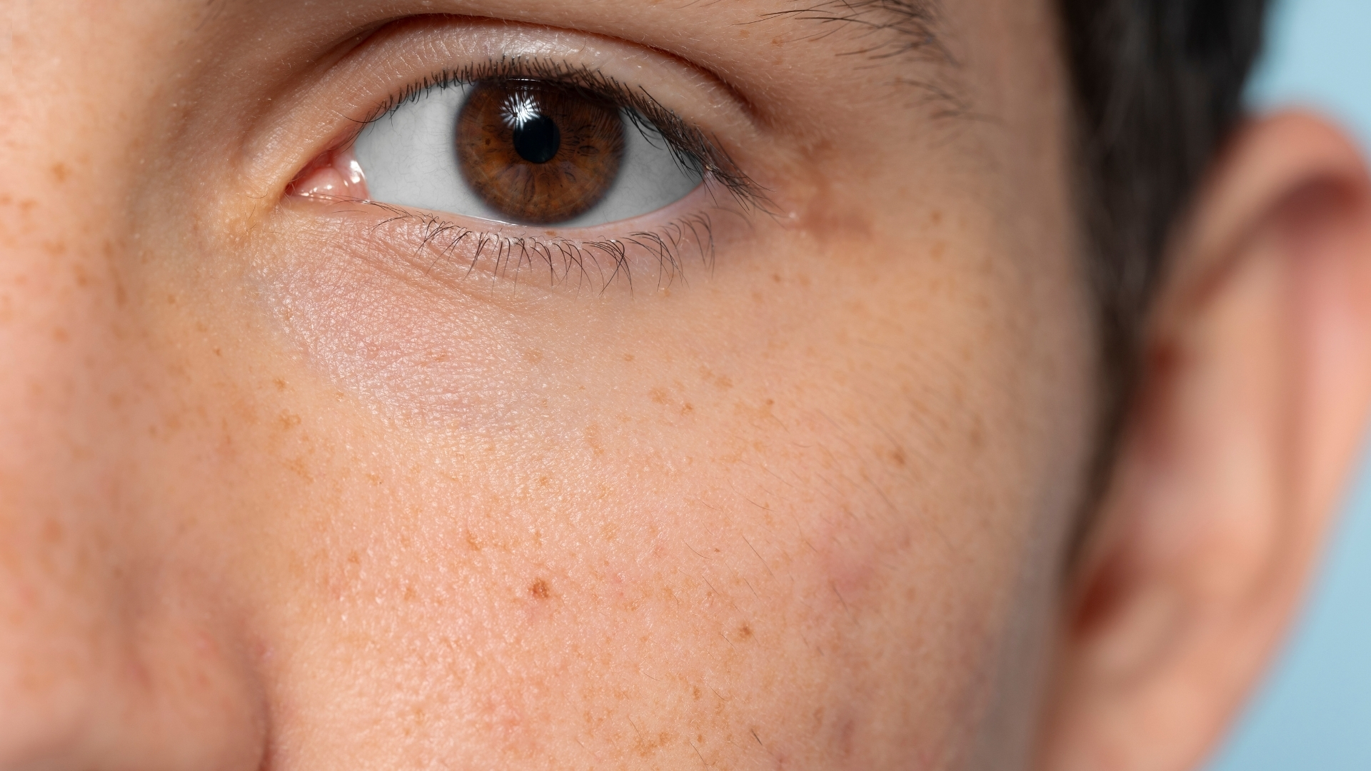 Dấu hiệu điển hình nhất của tàn nhang là sự xuất hiện của các đốm nhỏ, phẳng trên bề mặt da