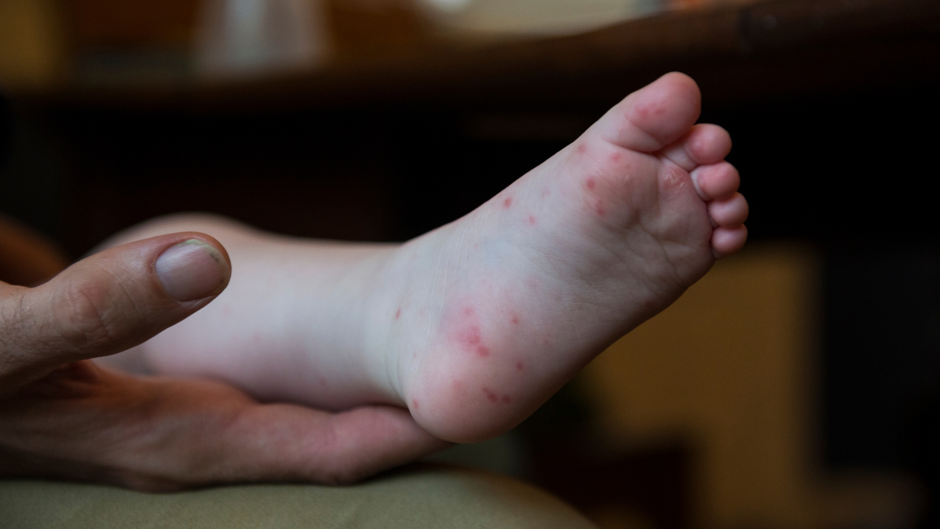 Nốt phát ban dạng phỏng nước do tay chân miệng