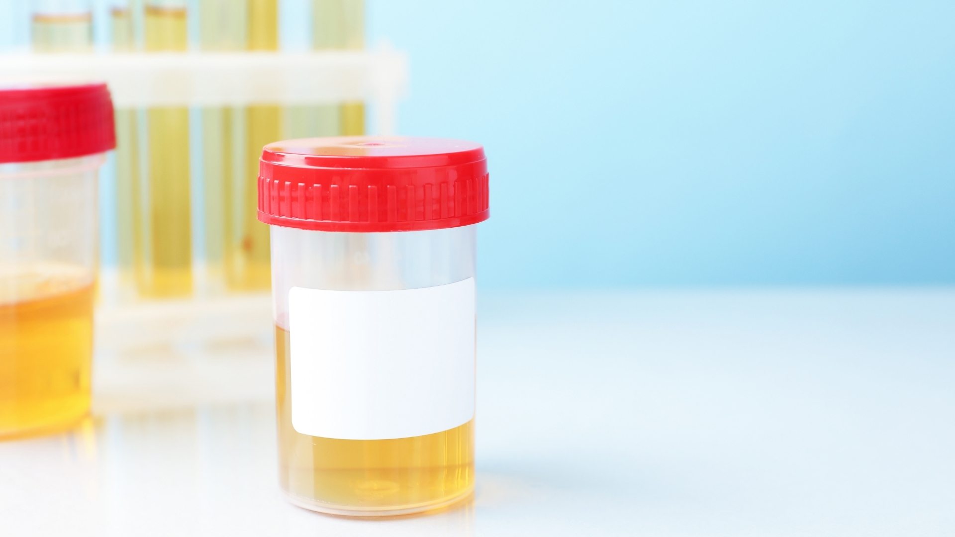 Phân tích nước tiểu là một phương pháp cơ bản và có giá trị trong chẩn đoán thận ứ mủ