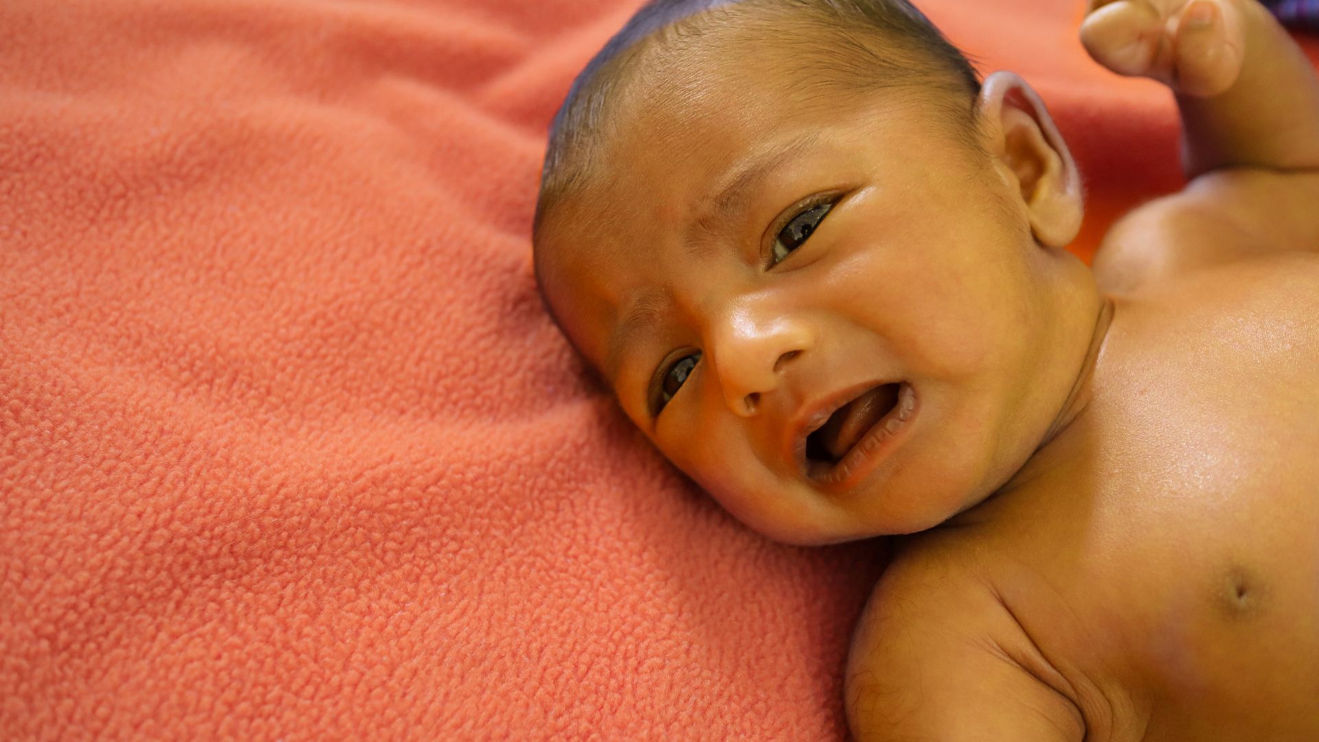 Vàng da, vàng mắt nhẹ do tan máu kéo dài là một triệu chứng của bệnh thiếu máu thalassemia