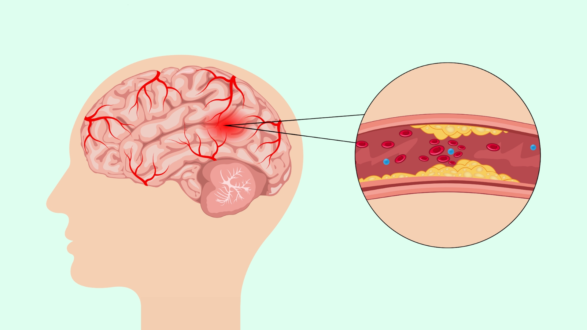 Xơ vữa động mạch gây tắc nghẽn hoặc thu hẹp mạch máu, khiến lưu lượng máu và oxy cung cấp cho não bị hạn chế