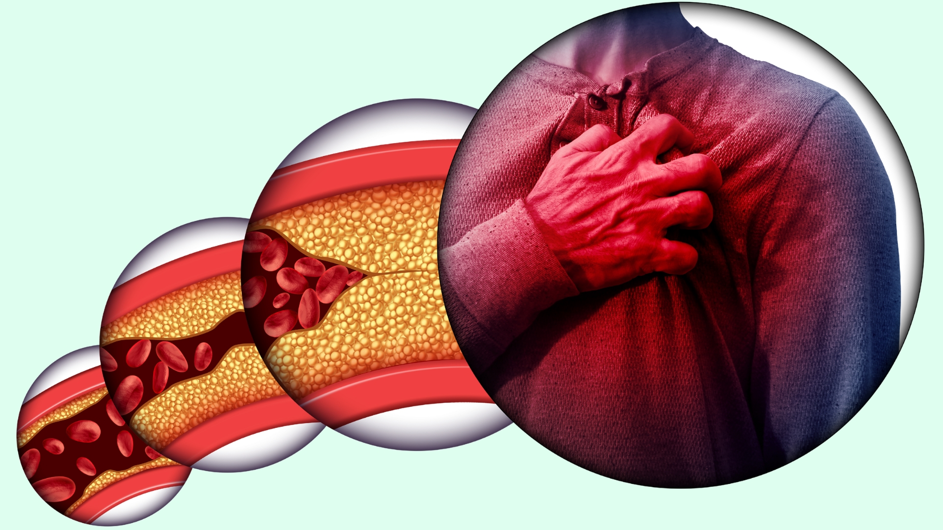 Nguyên nhân phổ biến nhất gây bệnh thiểu năng vành là xơ vữa động mạch