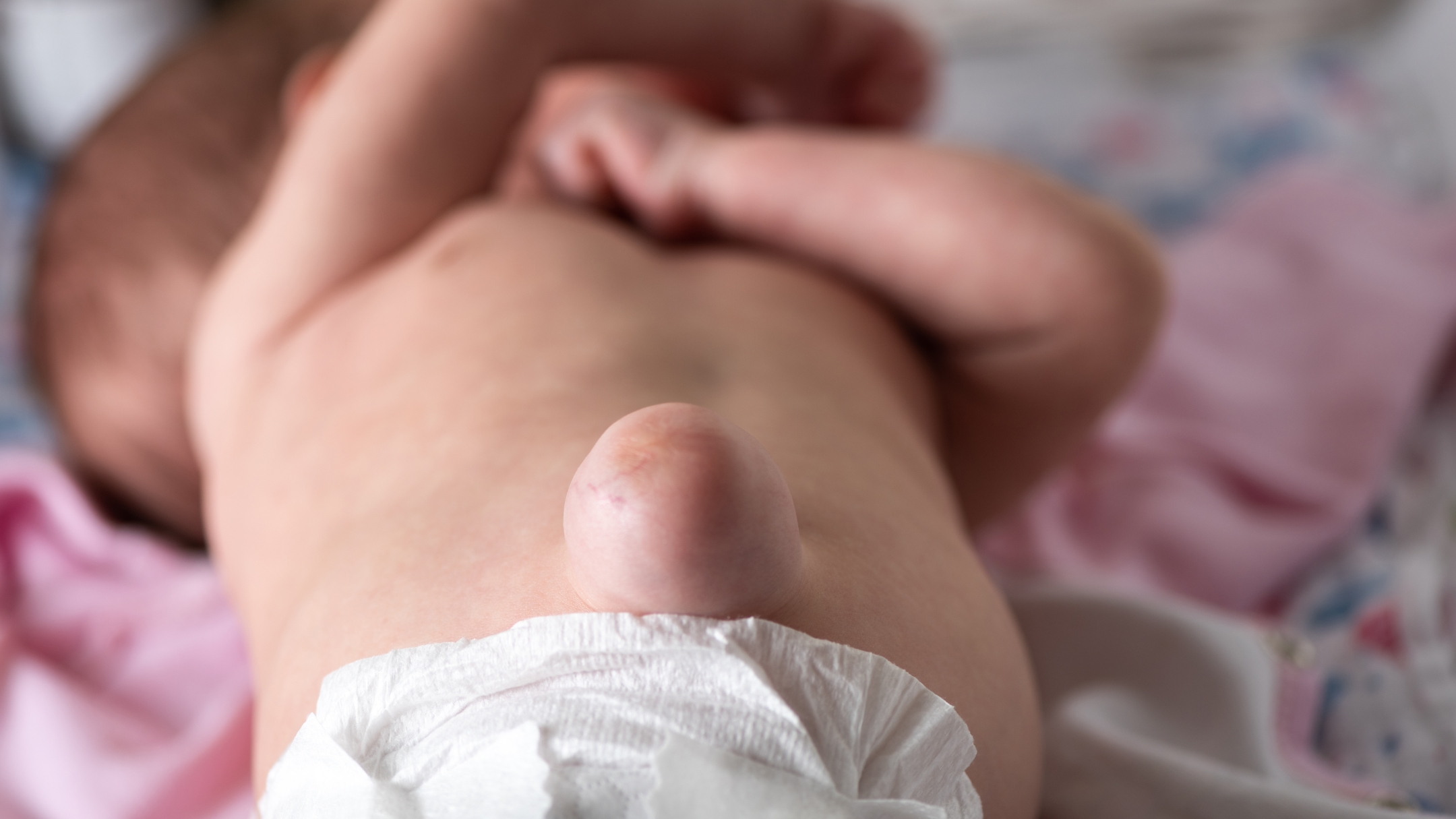 Ở trẻ sơ sinh và trẻ nhỏ, thoát vị rốn biểu hiện chủ yếu bằng việc rốn phồng to khi bé khóc, ho hoặc gắng sức