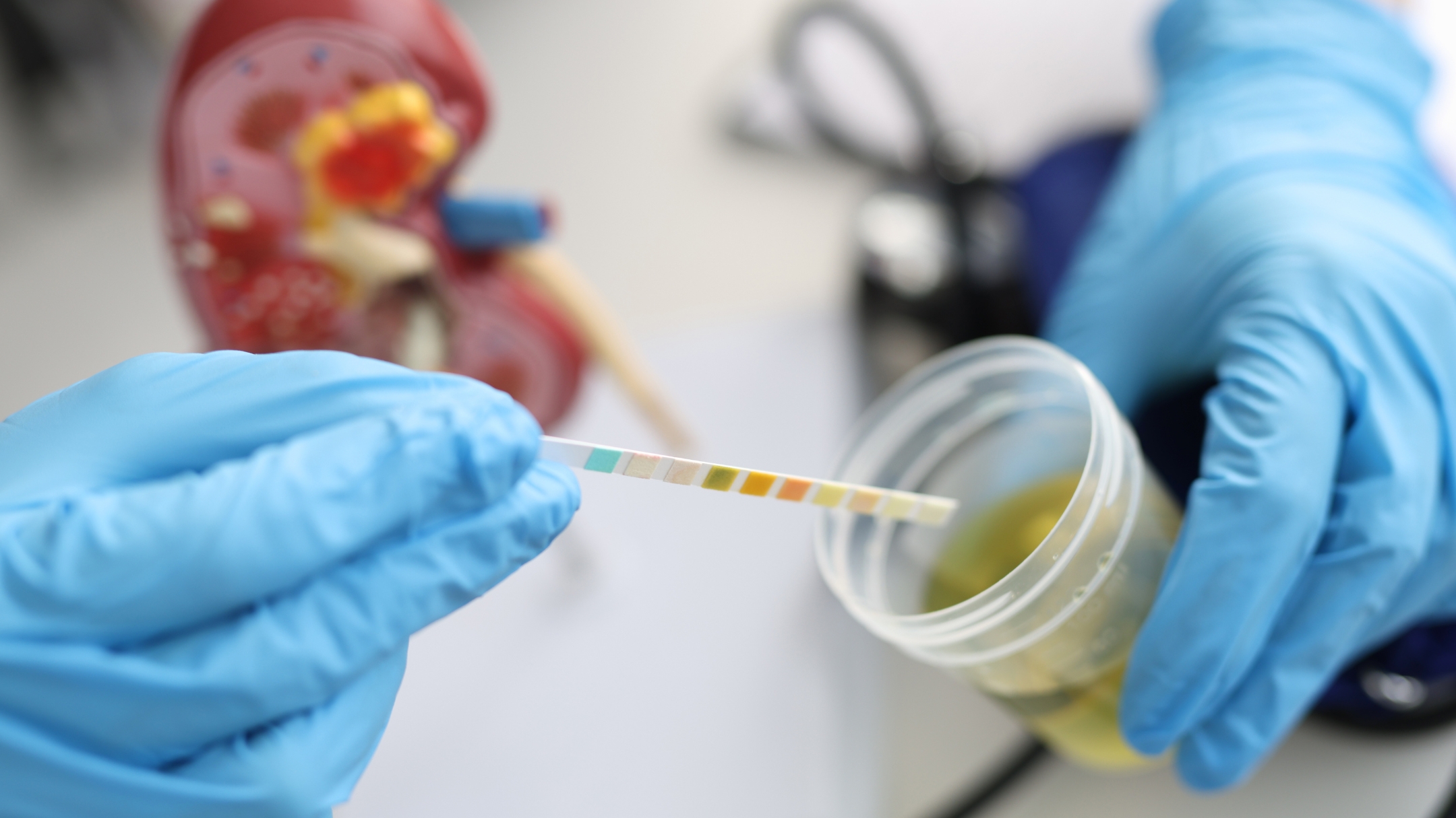 Nước tiểu sẽ được phân tích để tìm sự hiện diện của bạch cầu, hồng cầu, nitrit, protein hoặc glucose