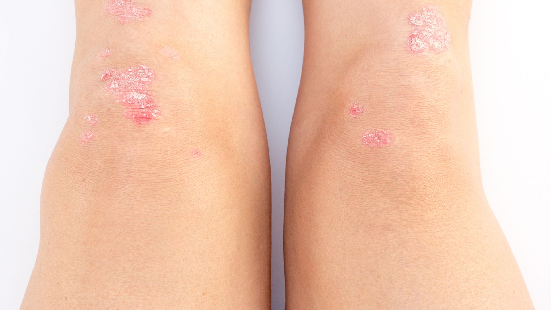 Va đập, té ngã hoặc chấn thương thể thao có thể gây tàn dịch khớp gối