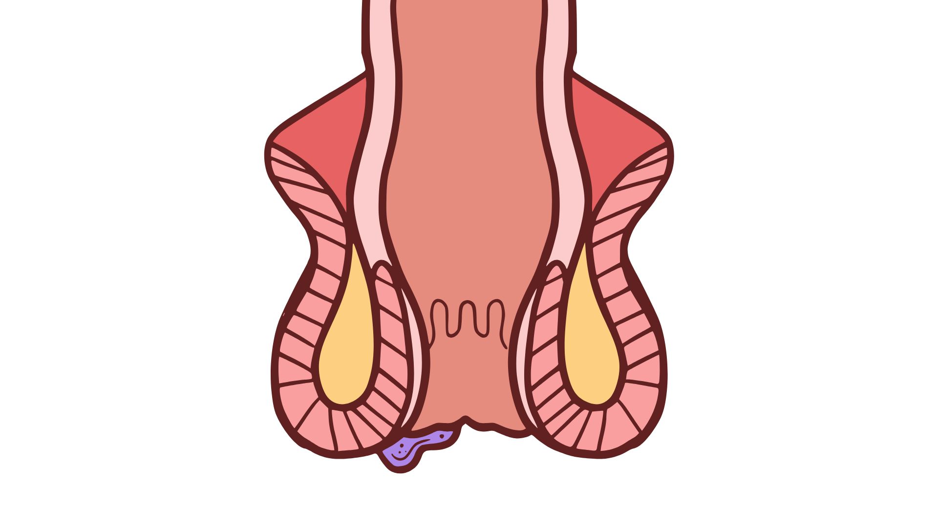 Trĩ ngoại với biểu hiện sưng hoặc xuất hiện búi trĩ ở rìa hậu môn