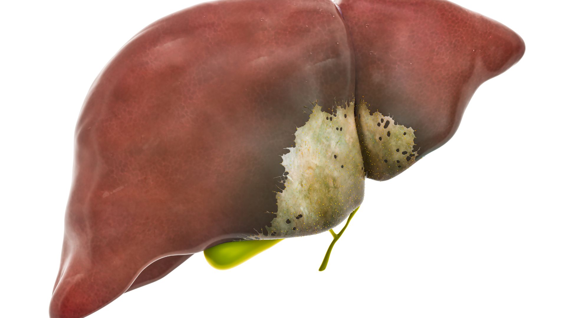 Bệnh có thể gây ảnh hưởng đến chức năng gan