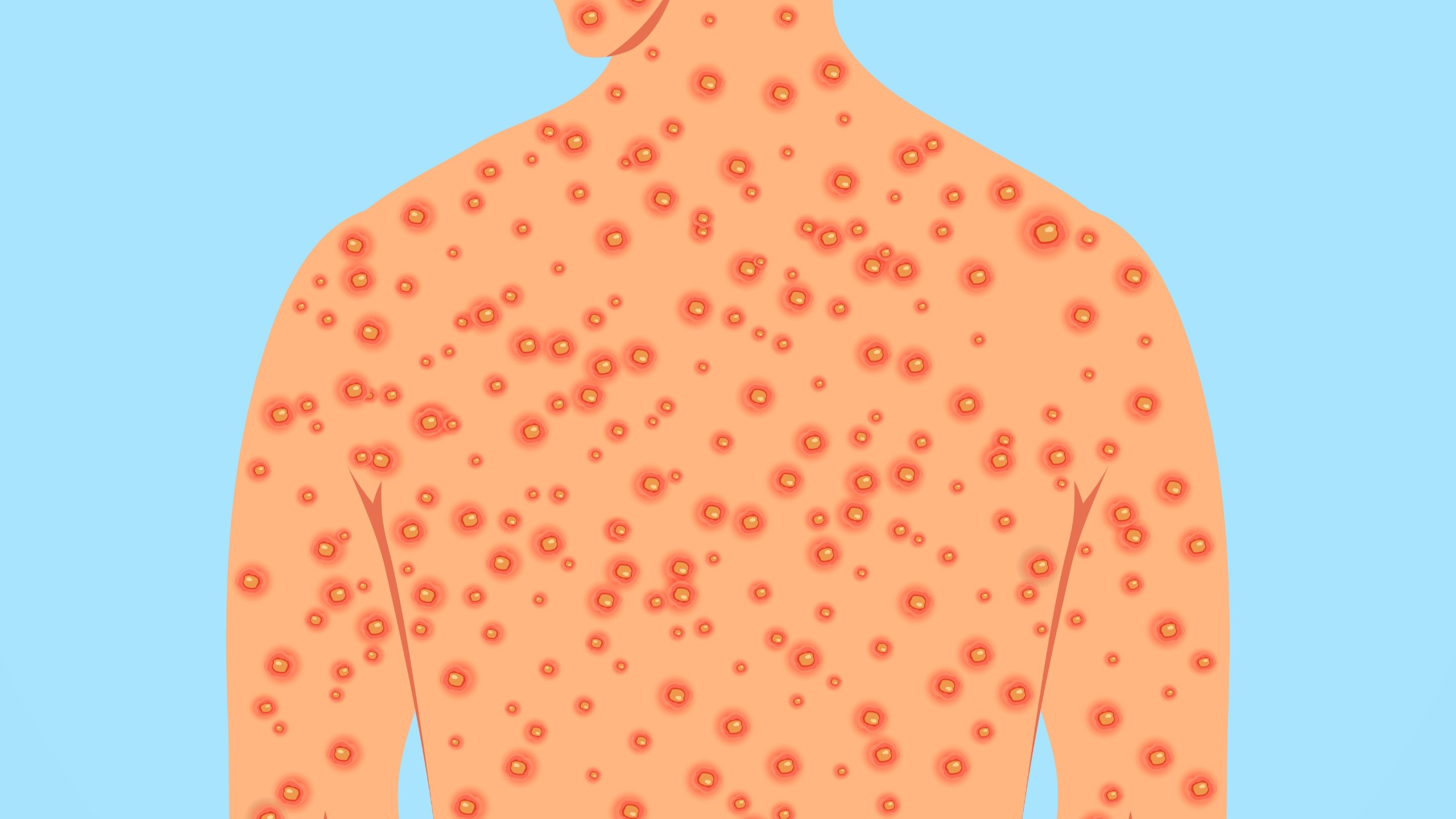 Bệnh&nbsp;u mềm lây có biểu hiện điển hình trên da