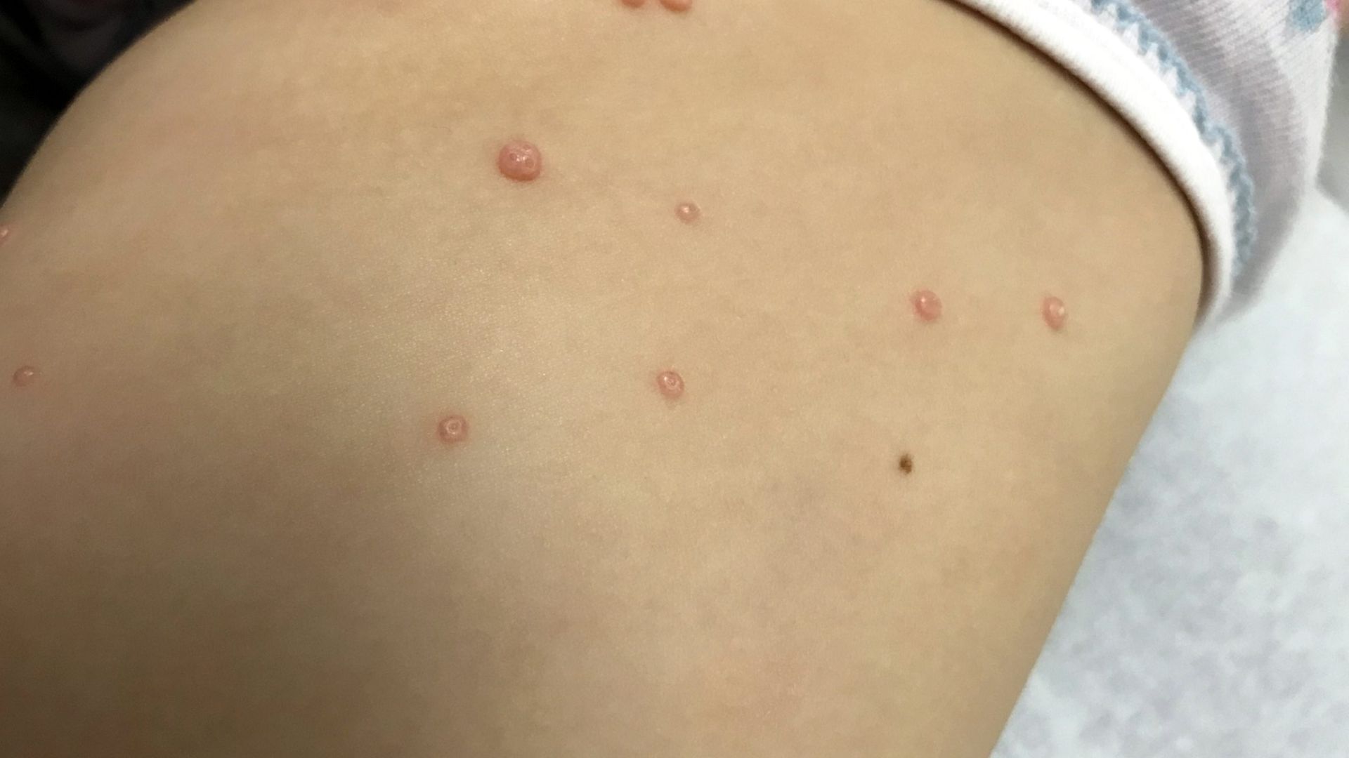 U mềm lây thường biểu hiện sẩn trên da, màu da hoặc màu trắng ngà