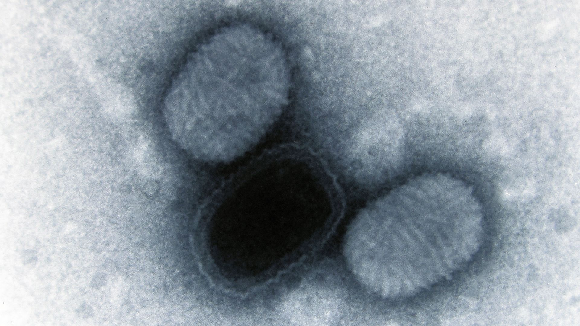 U mềm lây ở trẻ em là bệnh do nhiễm virus gây ra