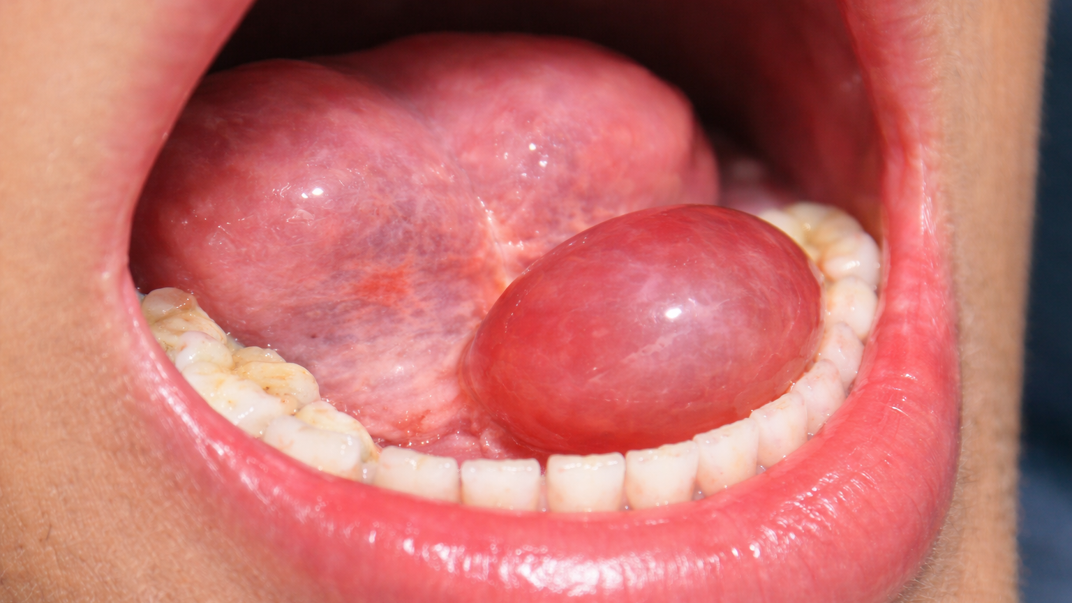 U nang dưới lưỡi quá to có thể gây đau và khó nuốt