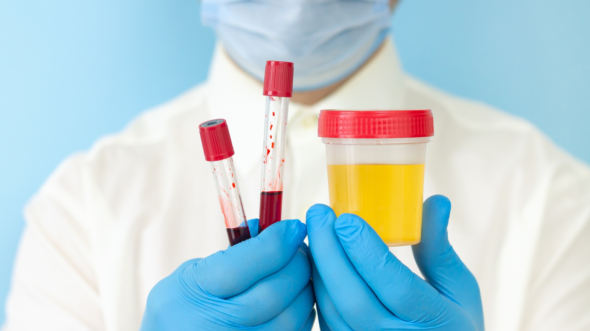 Xét nghiệm hormone trong máu và nước tiểu là bước nền tảng trong đánh giá u tuyến thượng thận