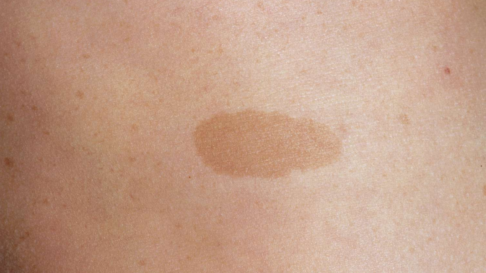 Các dát tăng sắc tố màu nâu nhạt xuất hiện trên da, bờ đều, kích thước thay đổi