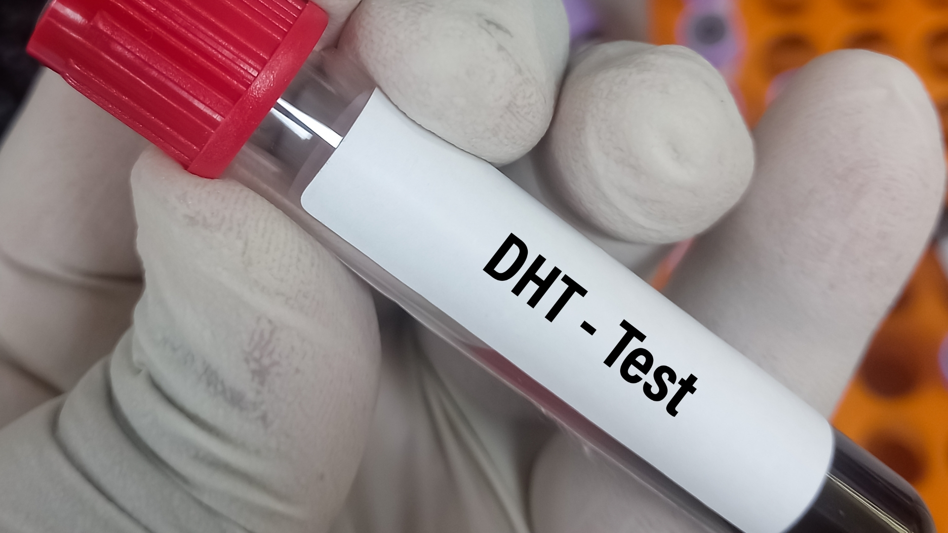 Dihydrotestosterone (DHT) tích tụ trong mô tuyến tiền liệt và kích thích tăng sinh tế bào