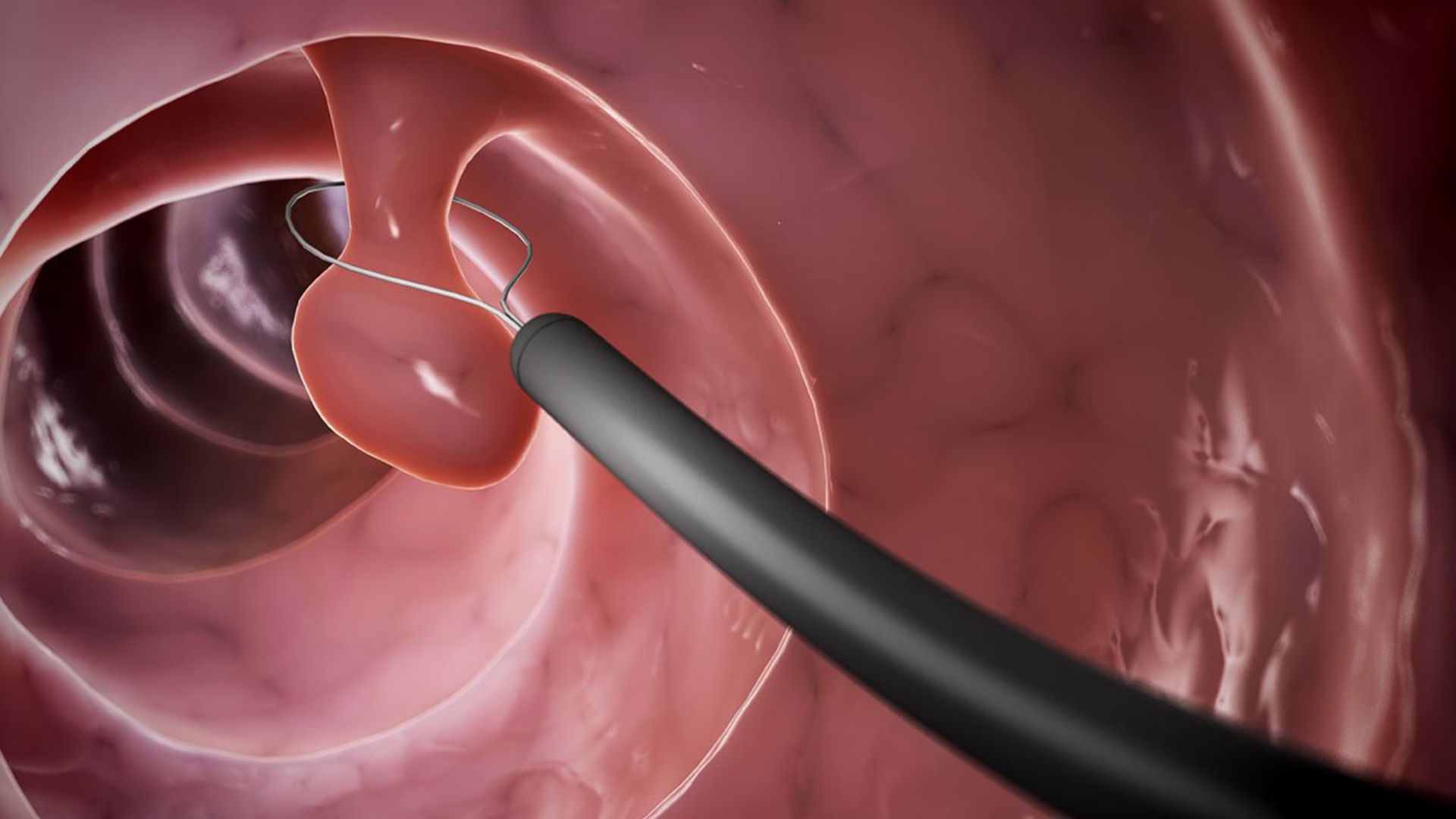 Tiền sử mắc polyp đại trực tràng là một trong những yếu tố nguy cơ