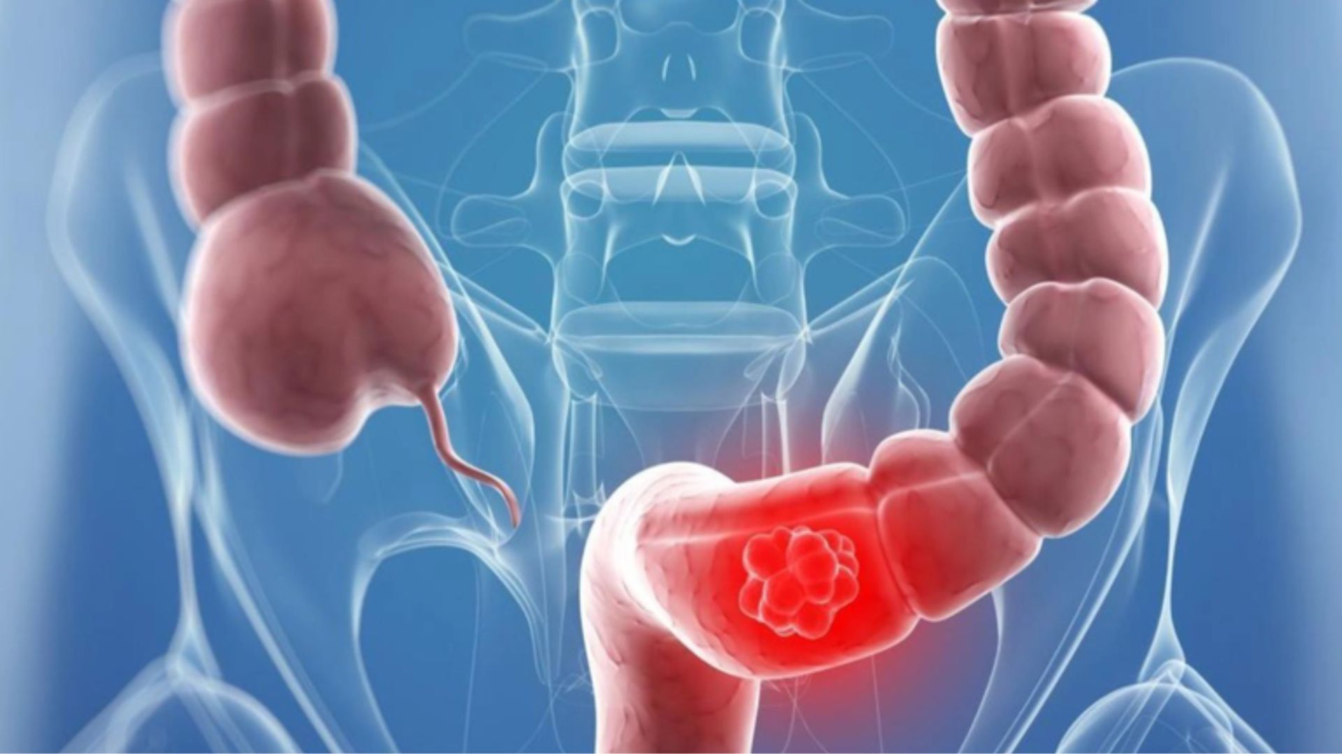 Ung thư phát triển có thể dẫn đến tắc ruột