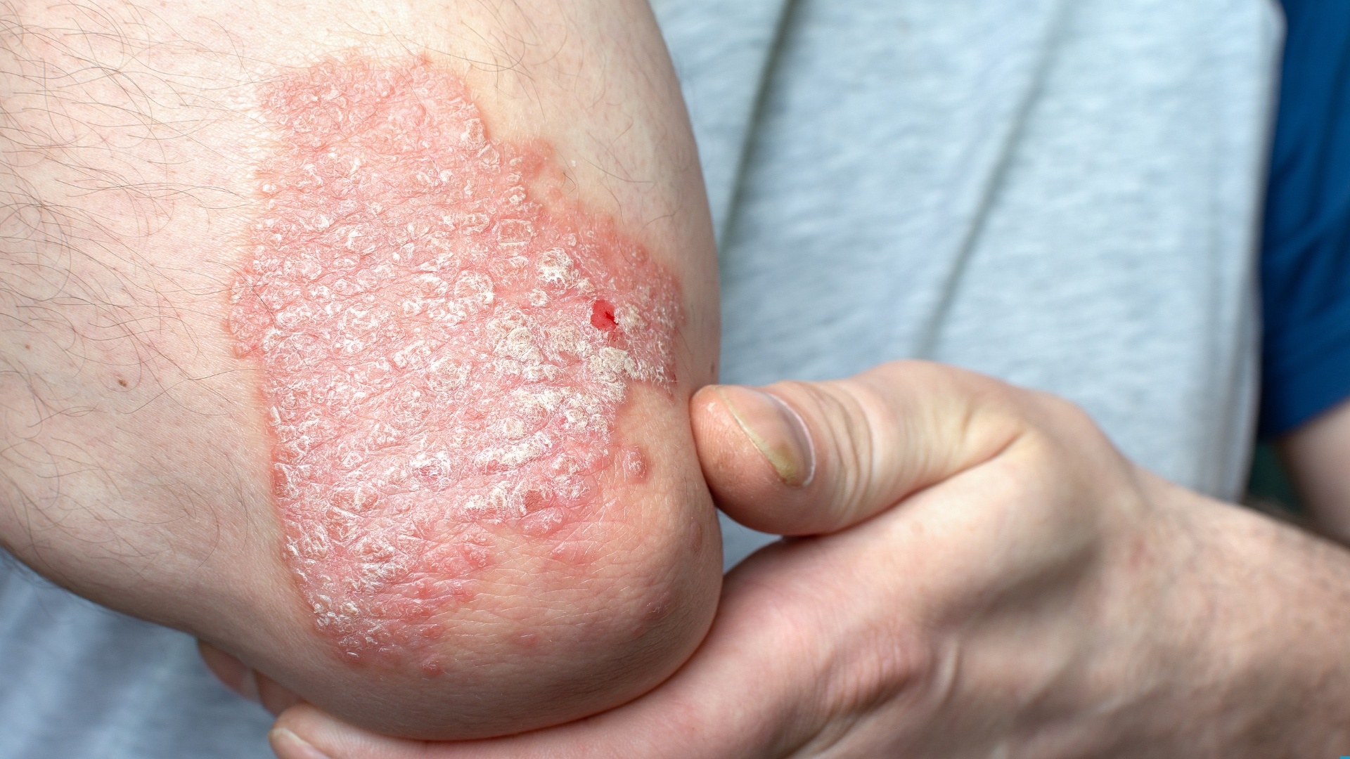 Mảng da đỏ có vảy trắng bạc là dấu hiệu điển hình và phổ biến nhất của vảy nến