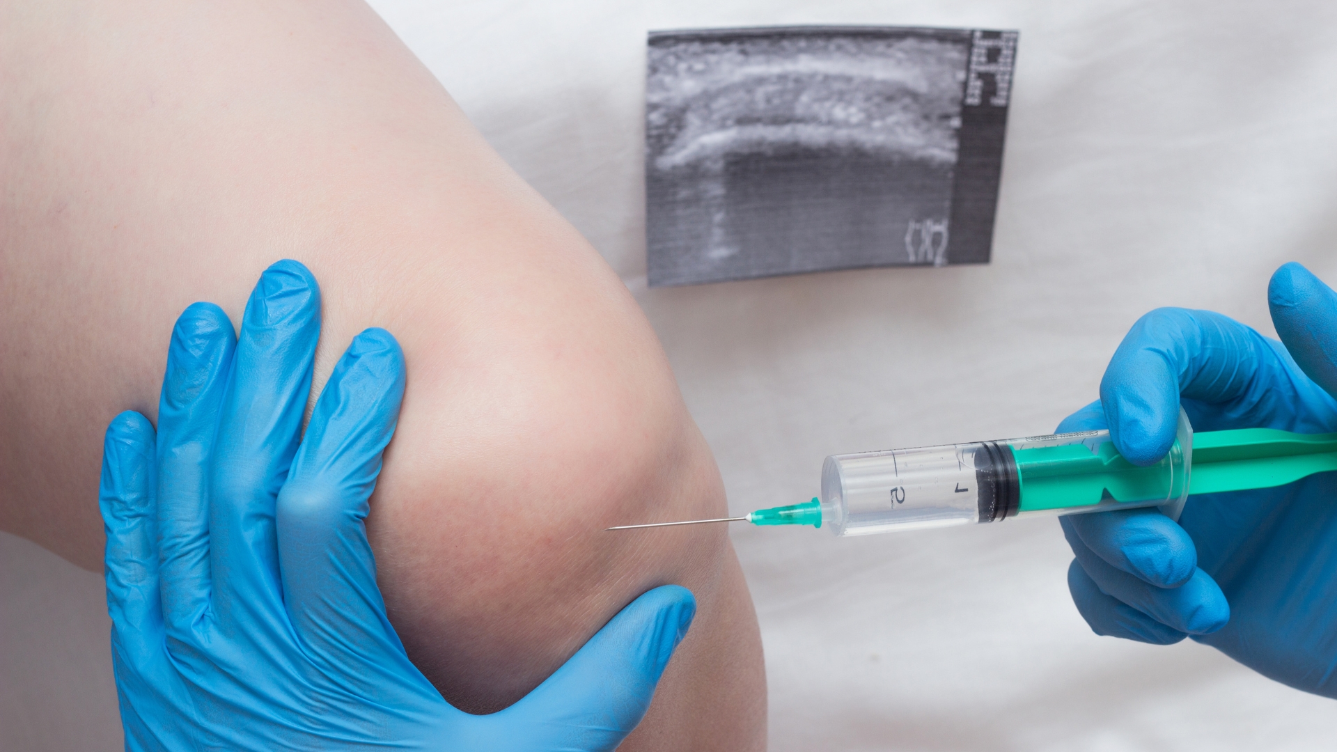 Khi bao hoạt dịch sưng to hoặc nghi ngờ viêm nhiễm, chọc hút dịch là kỹ thuật có giá trị chẩn đoán cao