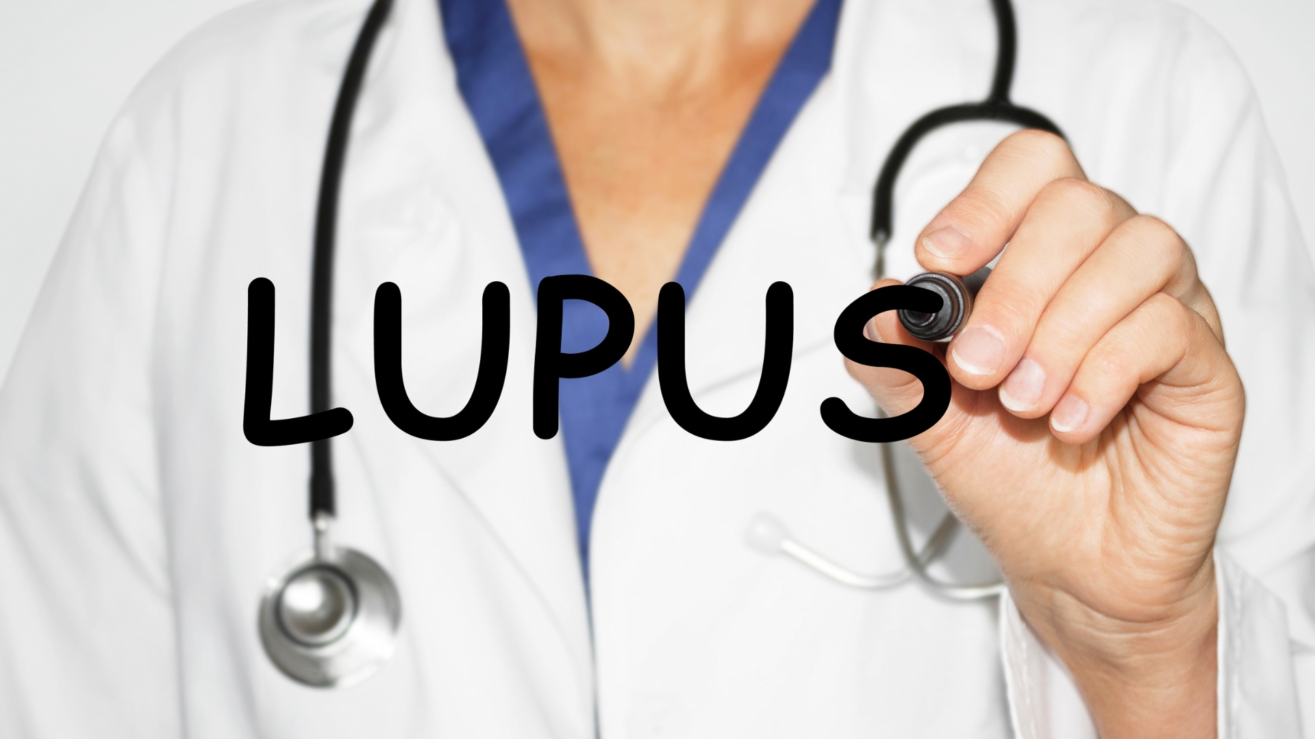Lupus ban đỏ hệ thống là một trong những bệnh tự miễn có thể gây viêm cầu thận cấp