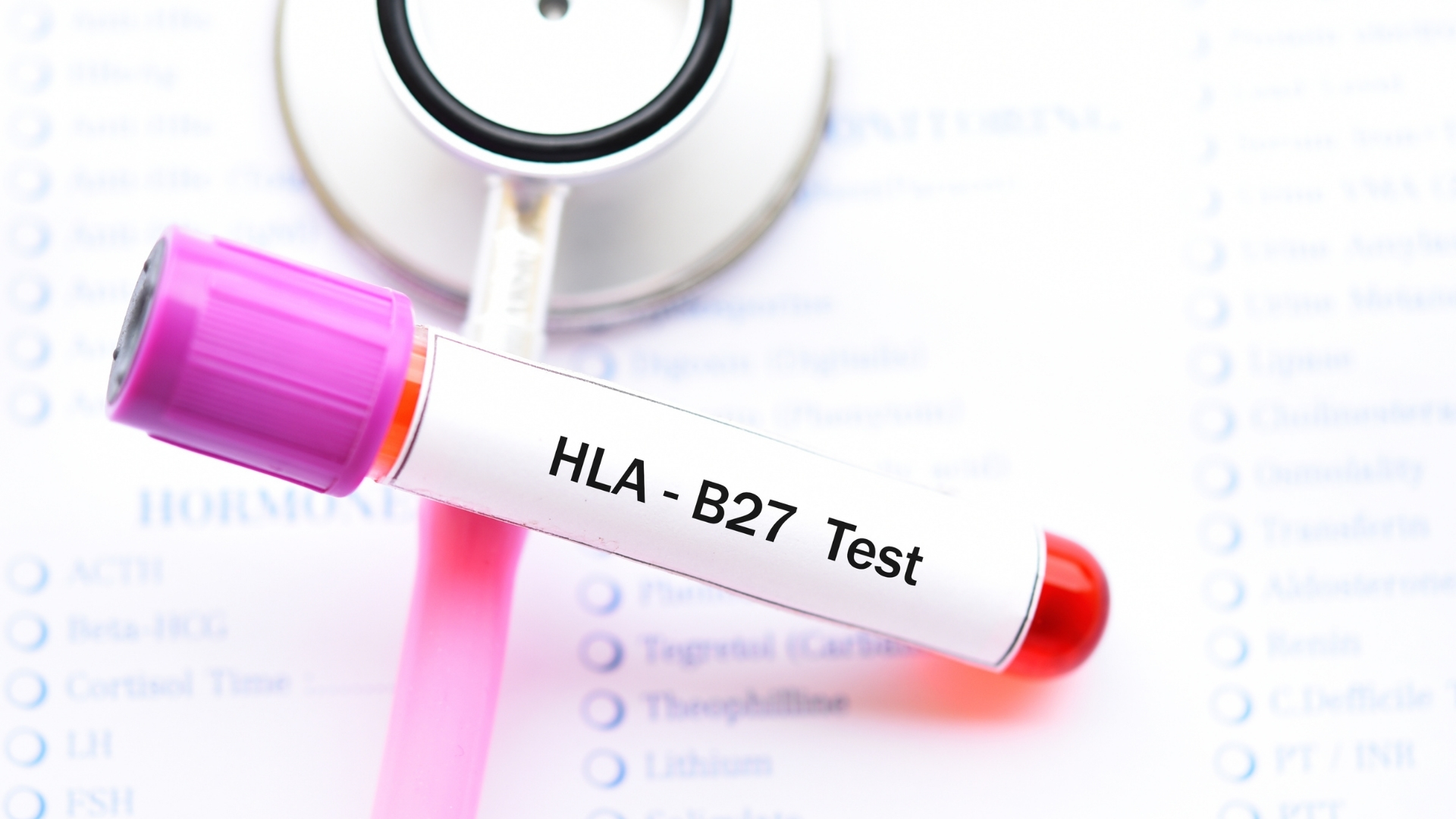 Khoảng 80 - 95% bệnh nhân viêm cột sống dính khớp có mang kháng nguyên HLA-B27