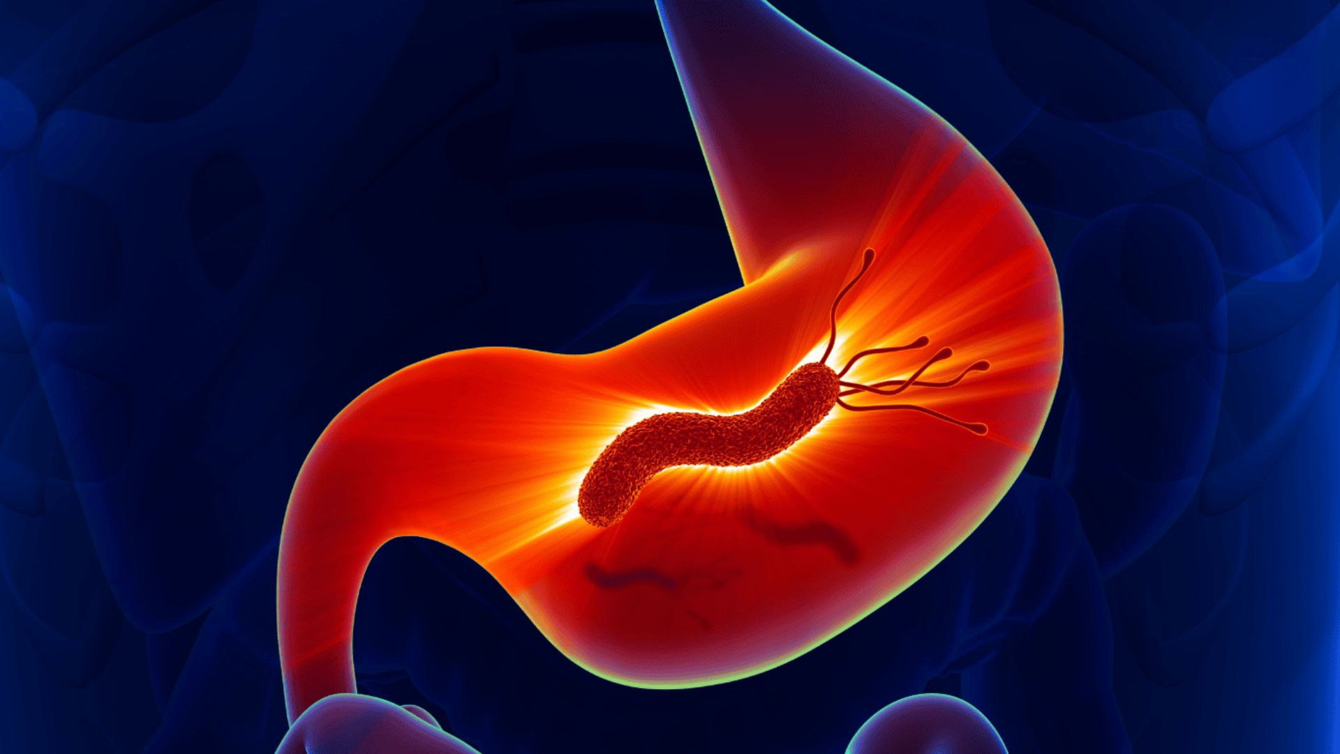 Nhiễm Hp là một trong những nguyên nhân gây viêm dạ dày