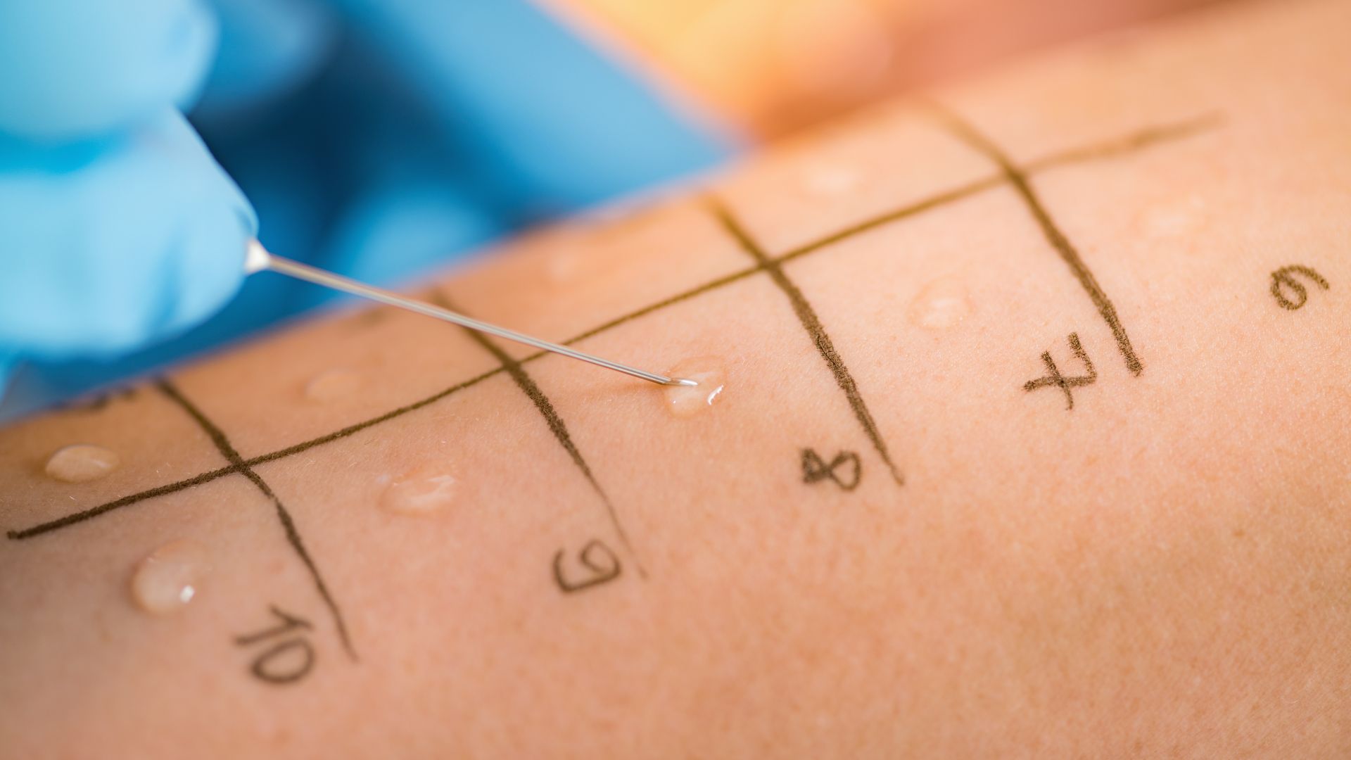 Test lẩy da giúp xác định dị nguyên cụ thể gây phản ứng dị ứng trên da