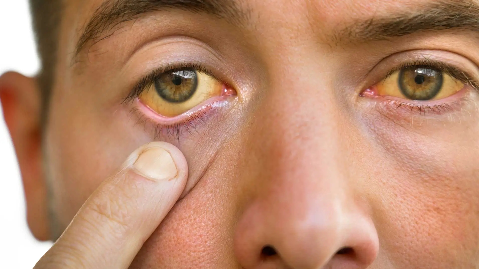 Khi gan bị tổn thương, khả năng xử lý sắc tố mật giảm, dẫn đến hiện tượng da và lòng trắng mắt chuyển vàng