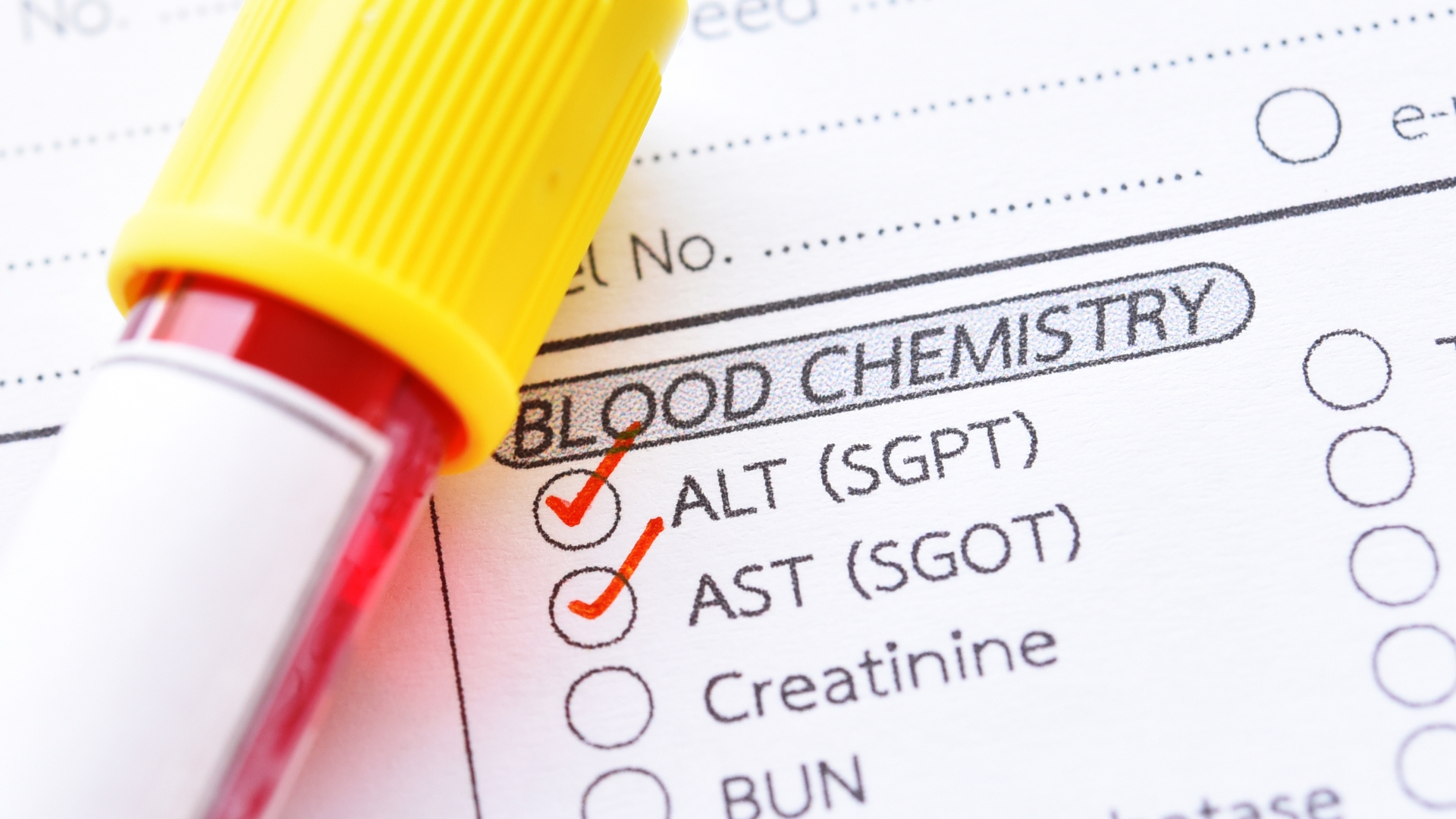 Xét nghiệm chức năng gan đo các chỉ số men gan như AST, ALT để đánh giá mức độ tổn thương tế bào gan