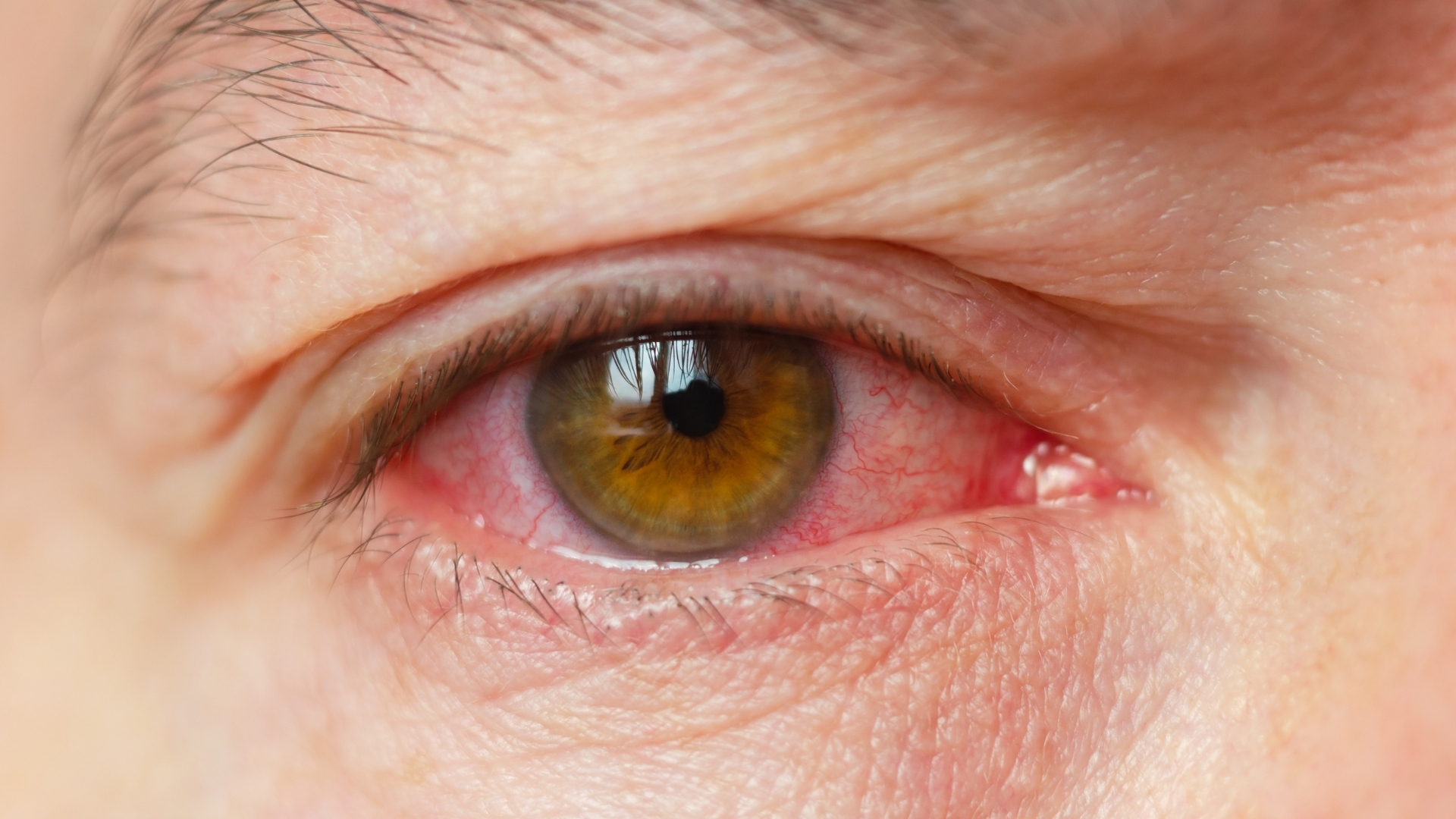 Đỏ mắt thường xuất hiện quanh vùng giác mạc do sung huyết kết mạc và mạch máu rìa giác mạc giãn nở