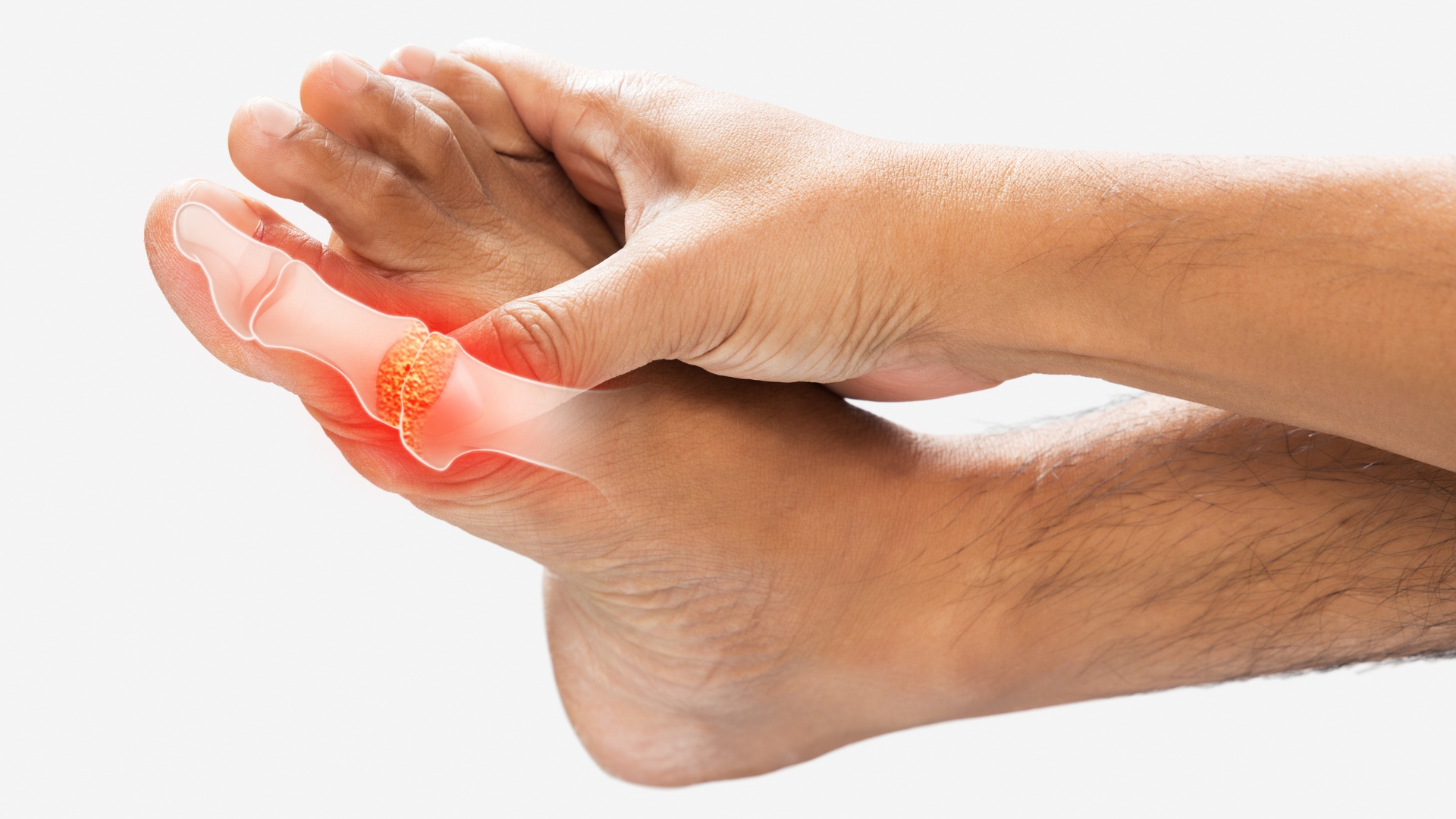 Gout là bệnh lý do lắng đọng tinh thể urat trong khớp, gây viêm cấp tính