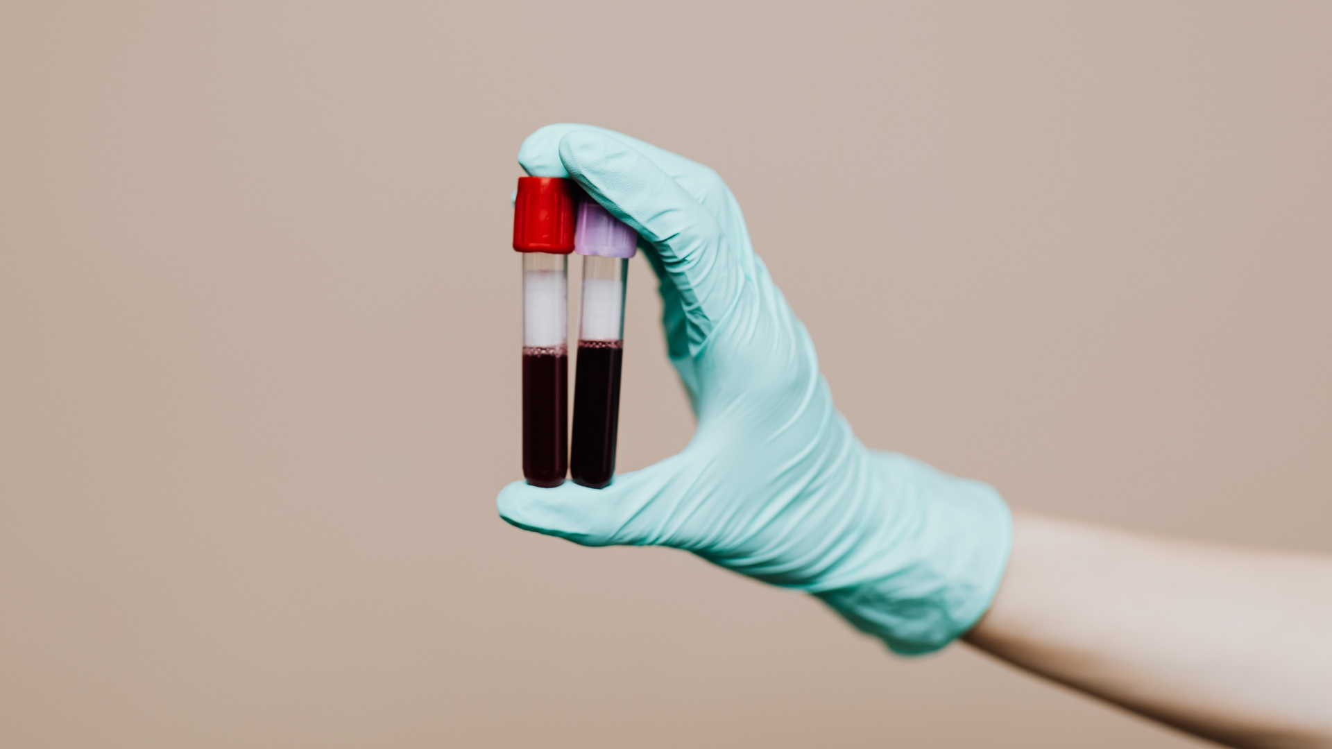 Các xét nghiệm máu giúp hỗ trợ chẩn đoán và phân loại thể bệnh