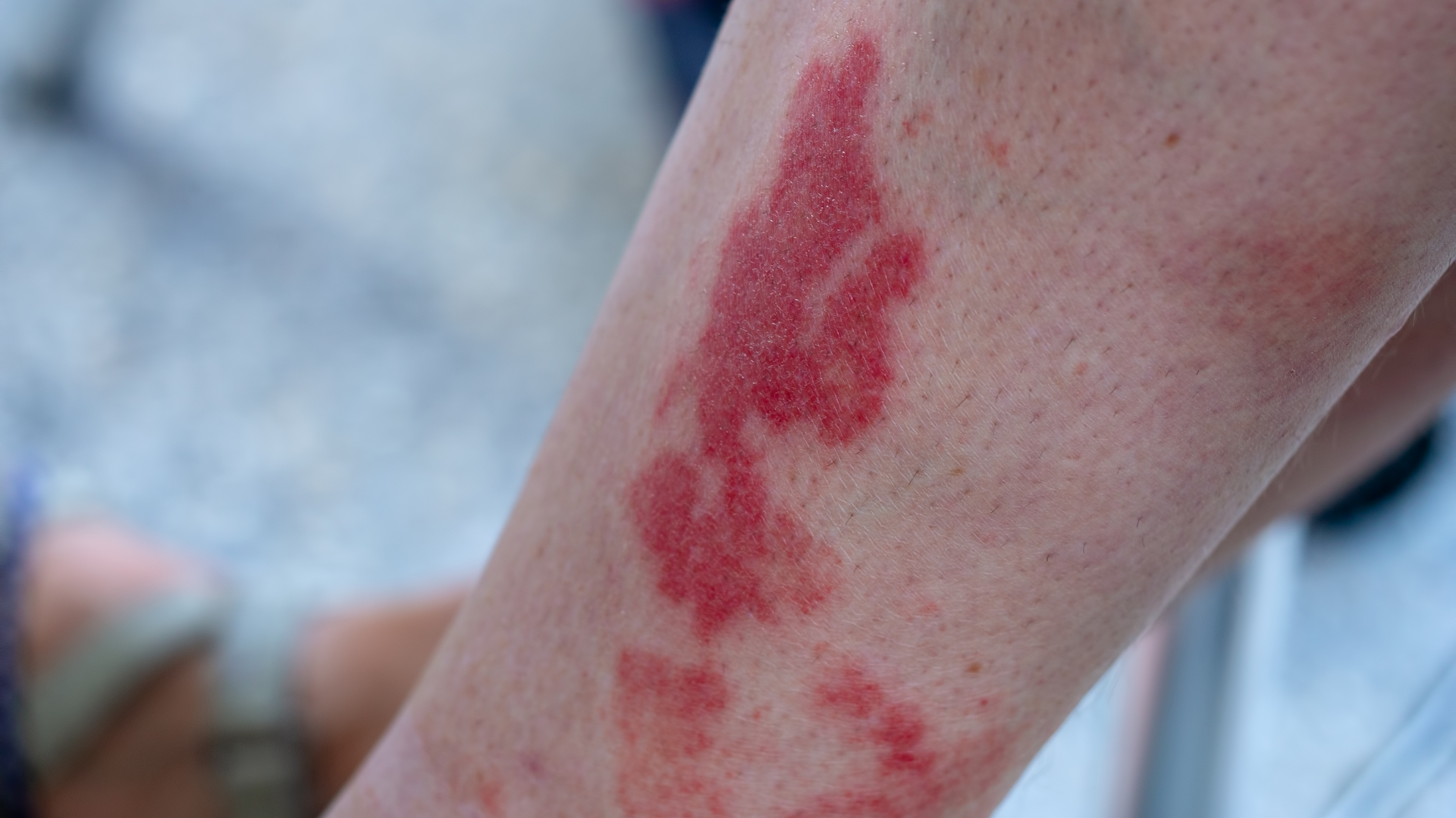 Viêm mạch làm xuất hiện ban xuất huyết dạng chấm hoặc mảng nổi gồ trên mặt da