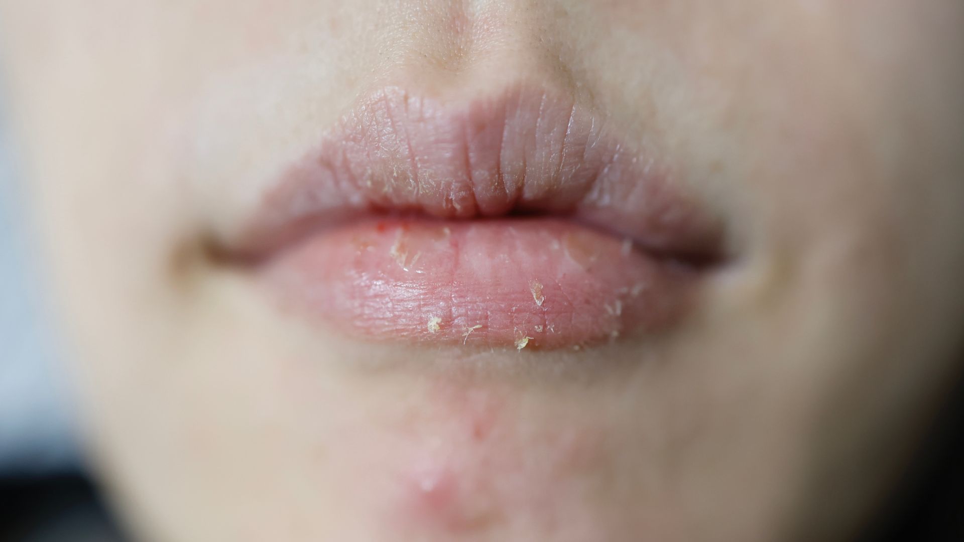 Người bệnh thường cảm thấy môi khô kéo dài, mất độ ẩm tự nhiên